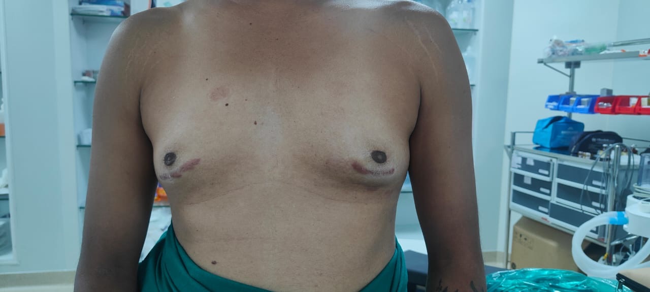 Patient operated by normal surgeon & given big ugly scars with complete recurrence 