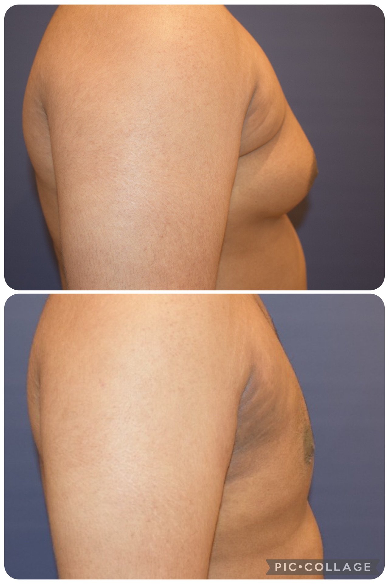 Results after 3 weeks of Massaging & pressure garment are amazing