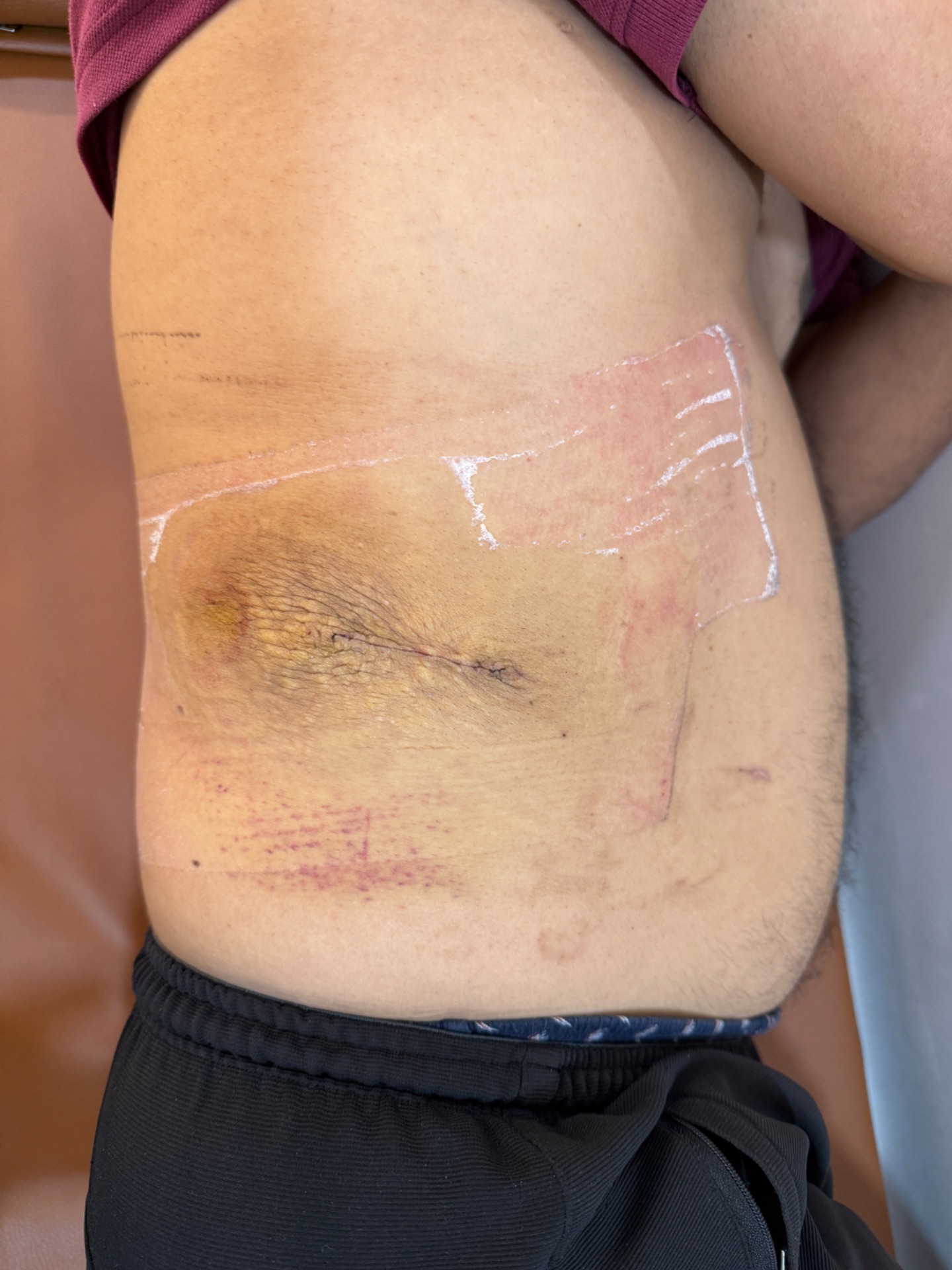 Plastic surgeon removed 35Cm lipoma through 3 cm hole with invisible scar