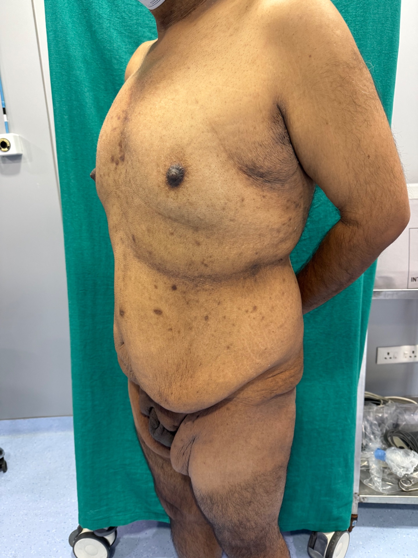 Notice loose hanging abdominal skin