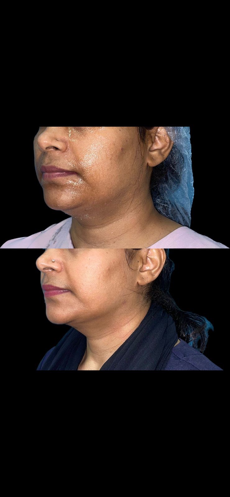 Results of chin implant and jawline contouring 