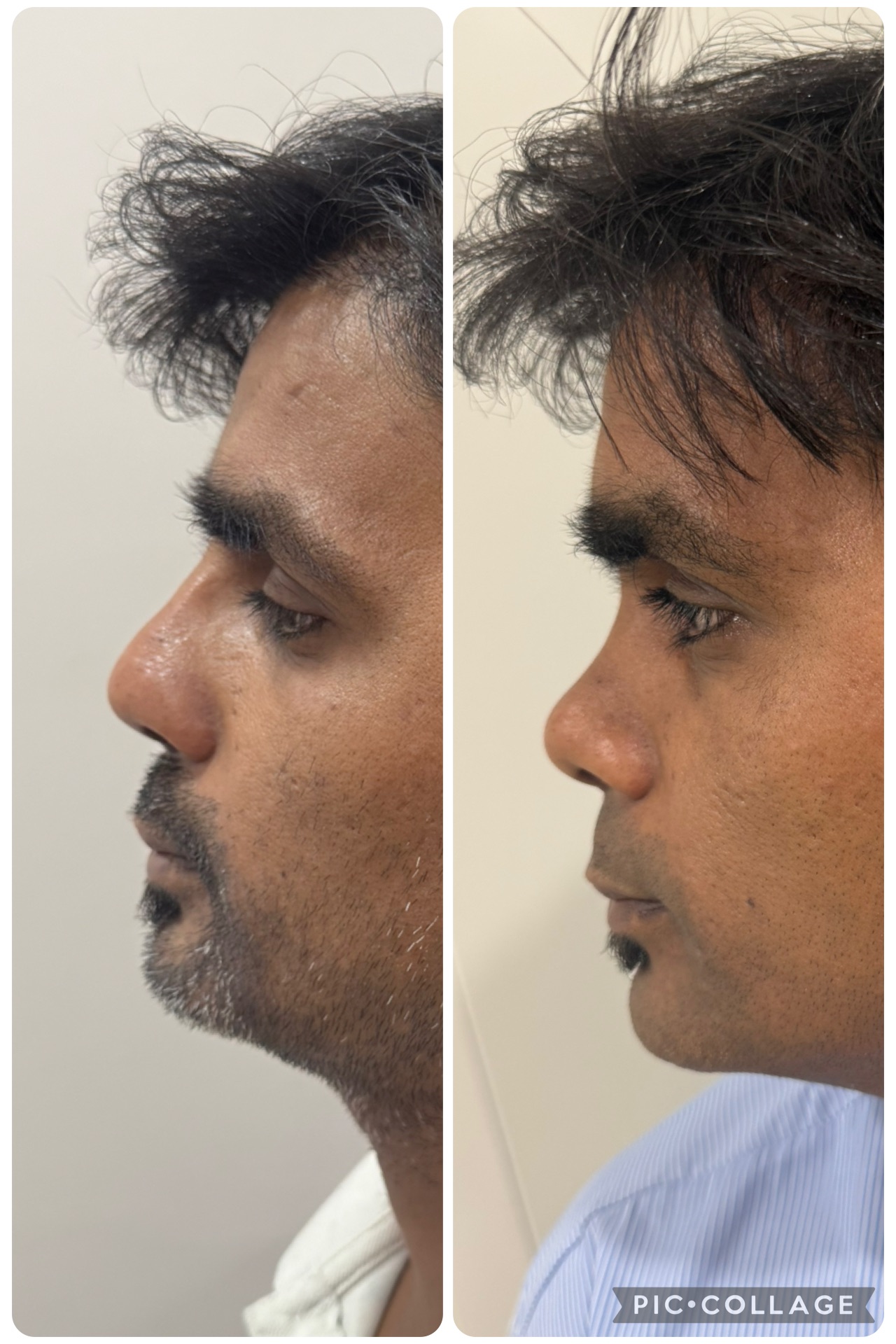 See the gross difference after elevation