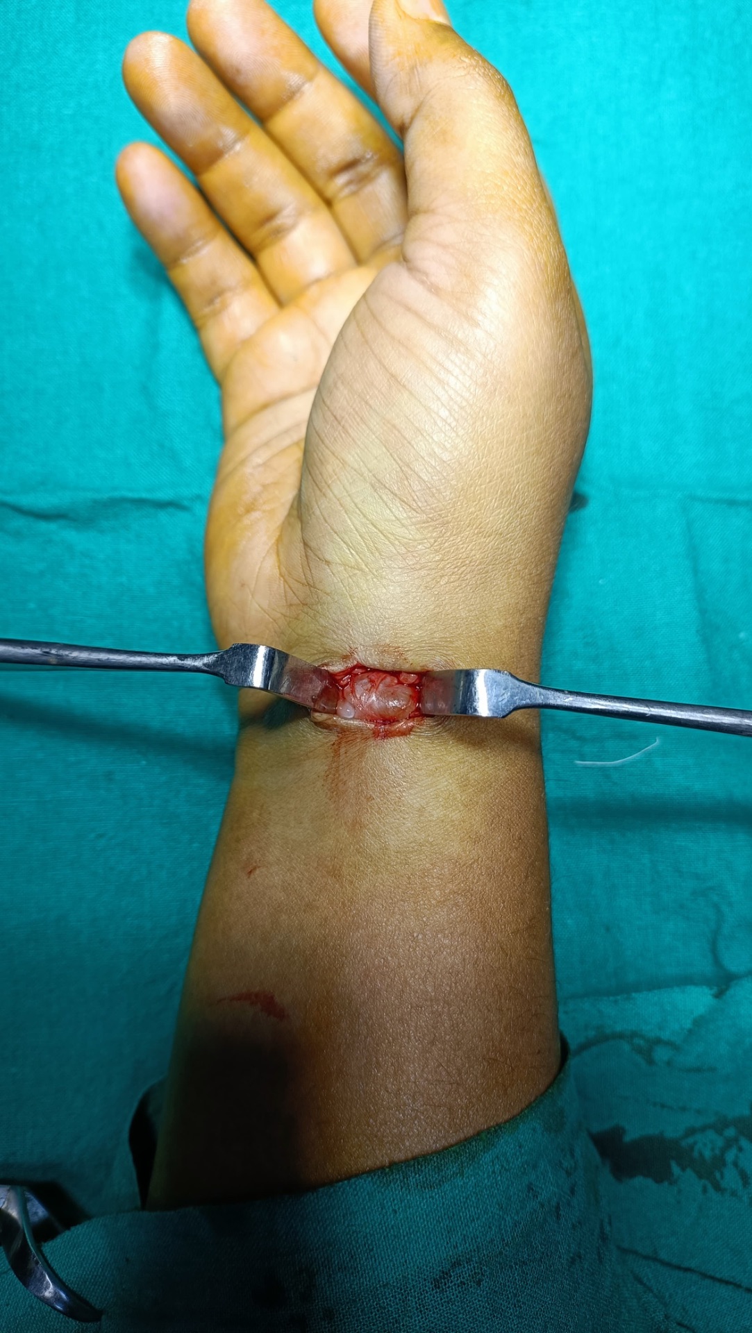 Volar cyst is more critical 