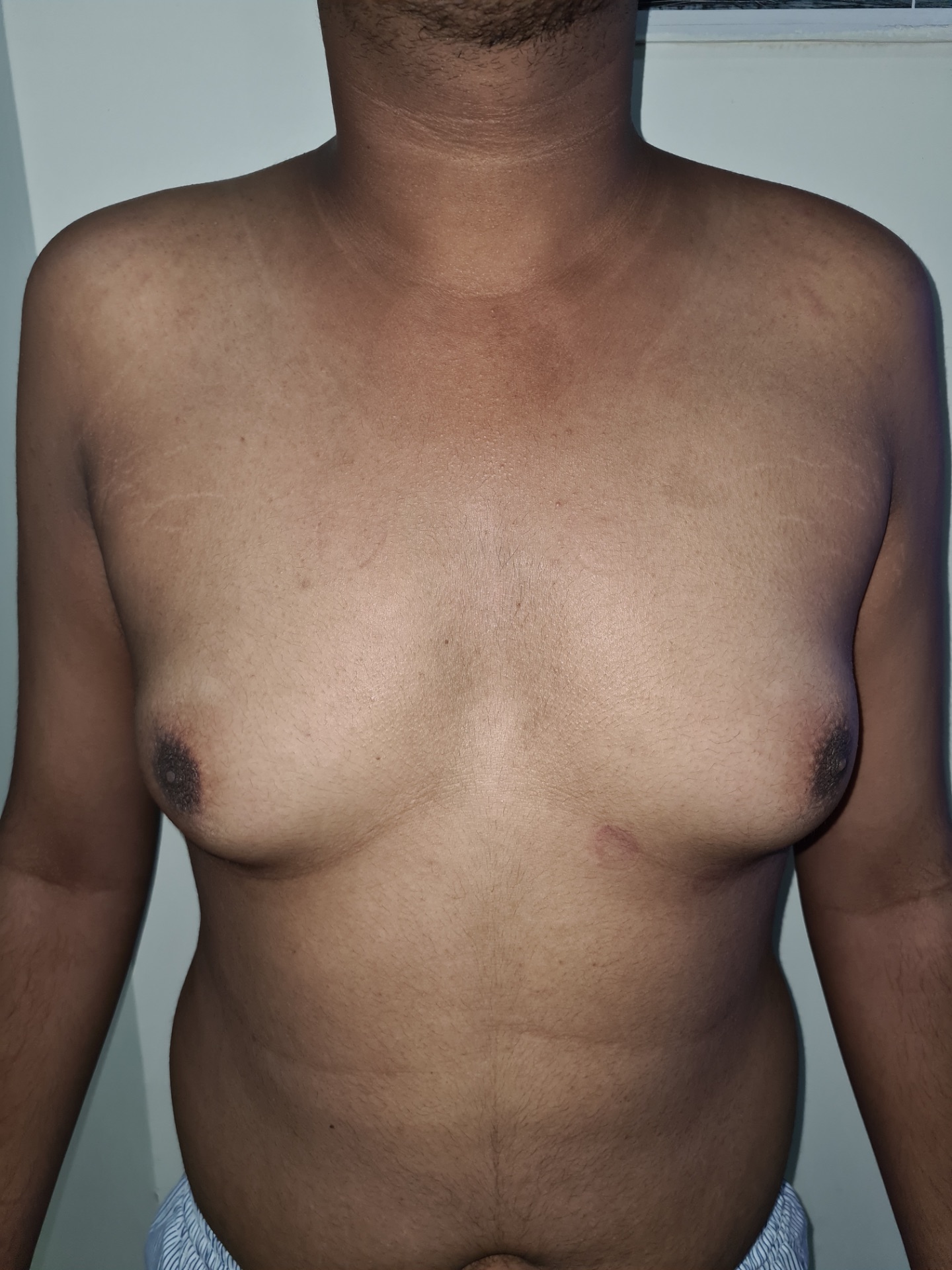 Gynecomastia Surgery Options