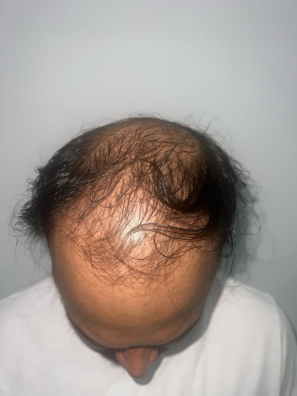 Hair Transplant Permanent