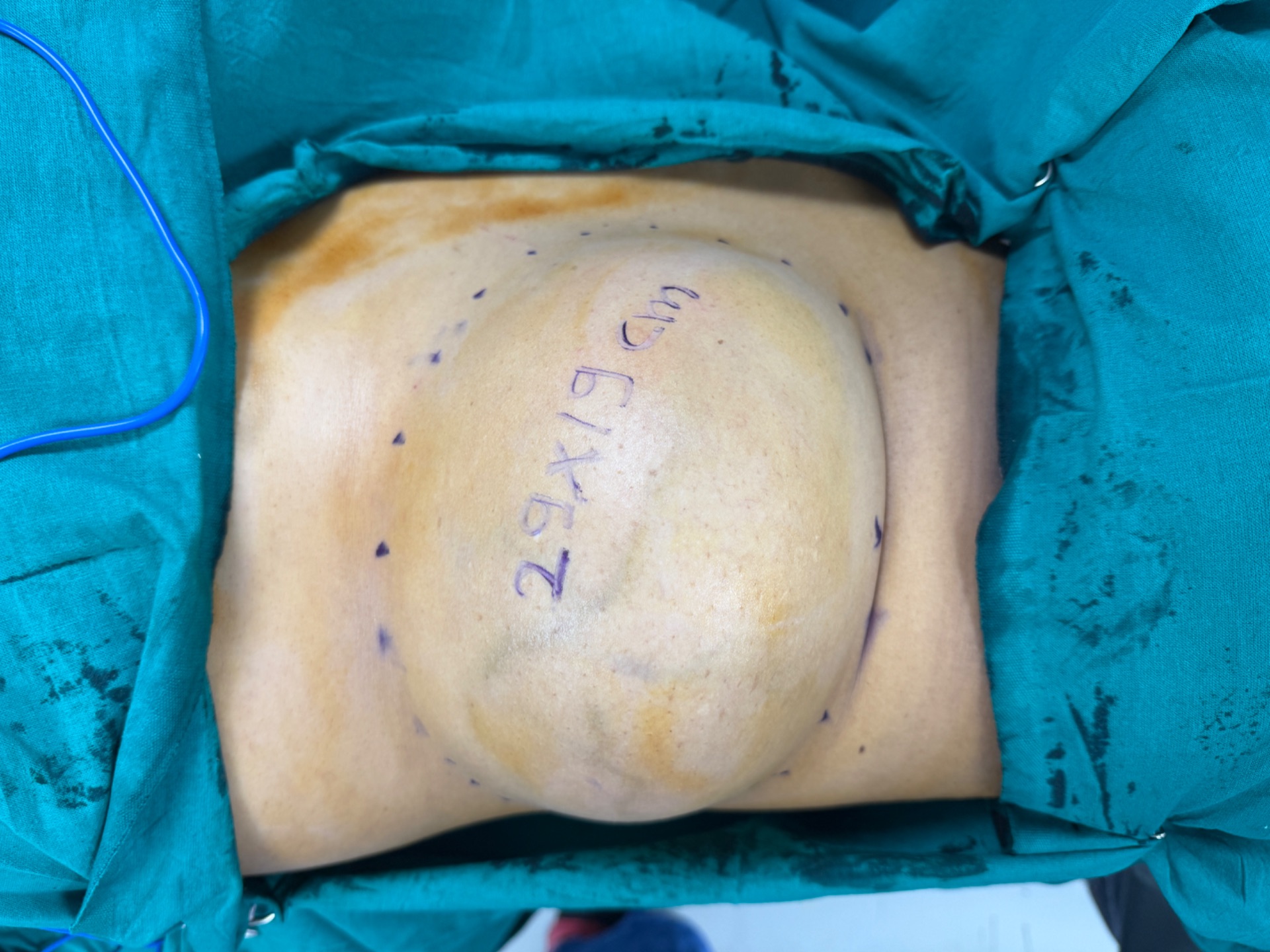 Lipoma can grow huge in size 