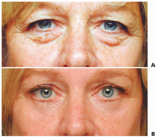 Bilateral upper and lower lid Blepharoplasty 