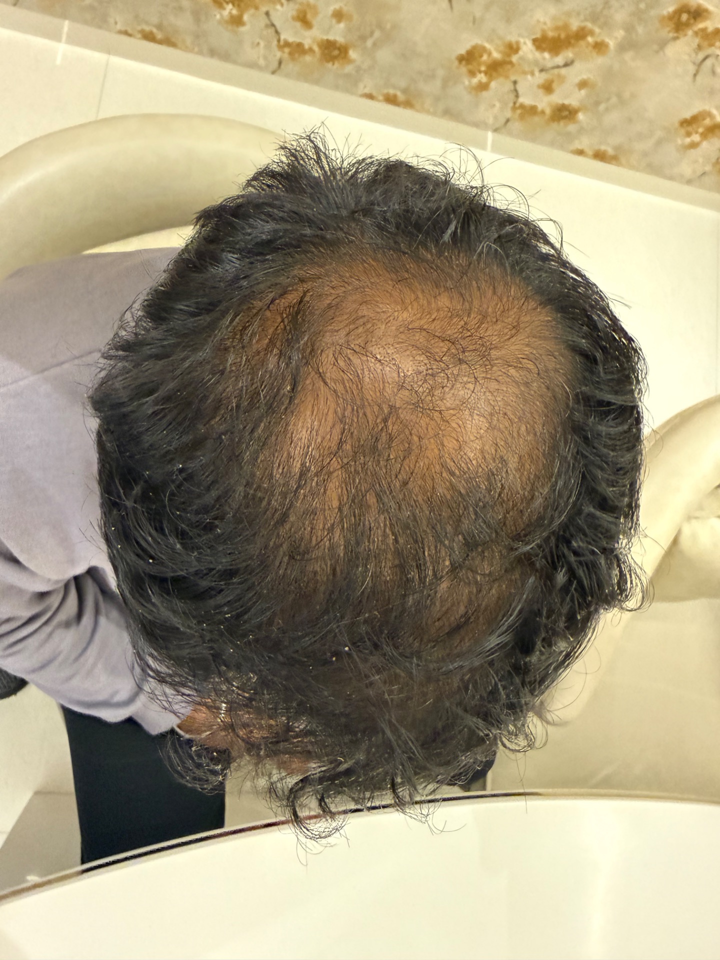 27 year male with vertex patch and very low density 