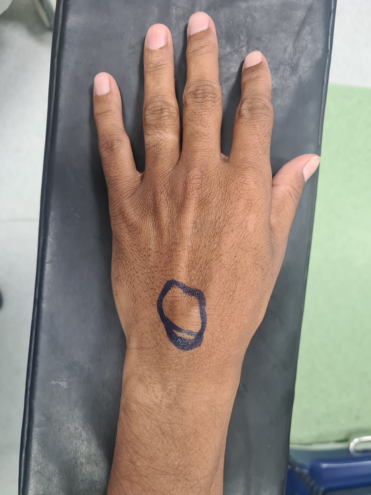 Ganglion Cyst or Wrist Swelling