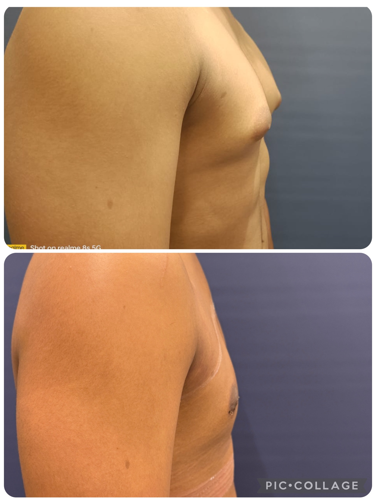 Most popular daycare surgery, see immediate results on 2nd day
