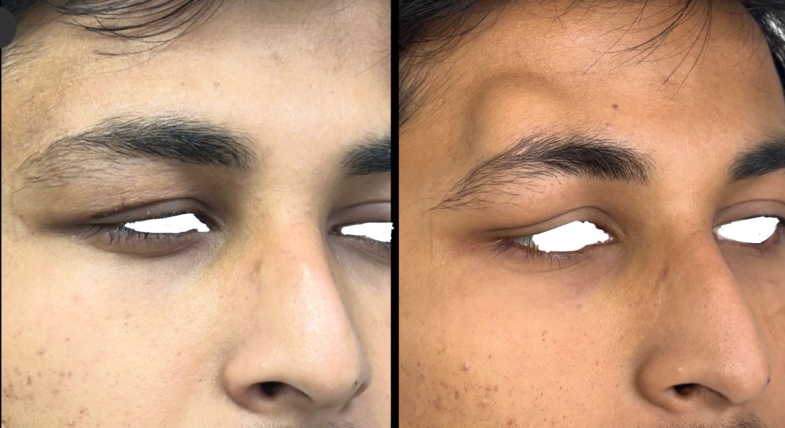 Face lipomas and swelling excised by Plastic Surgeon with NO scars 