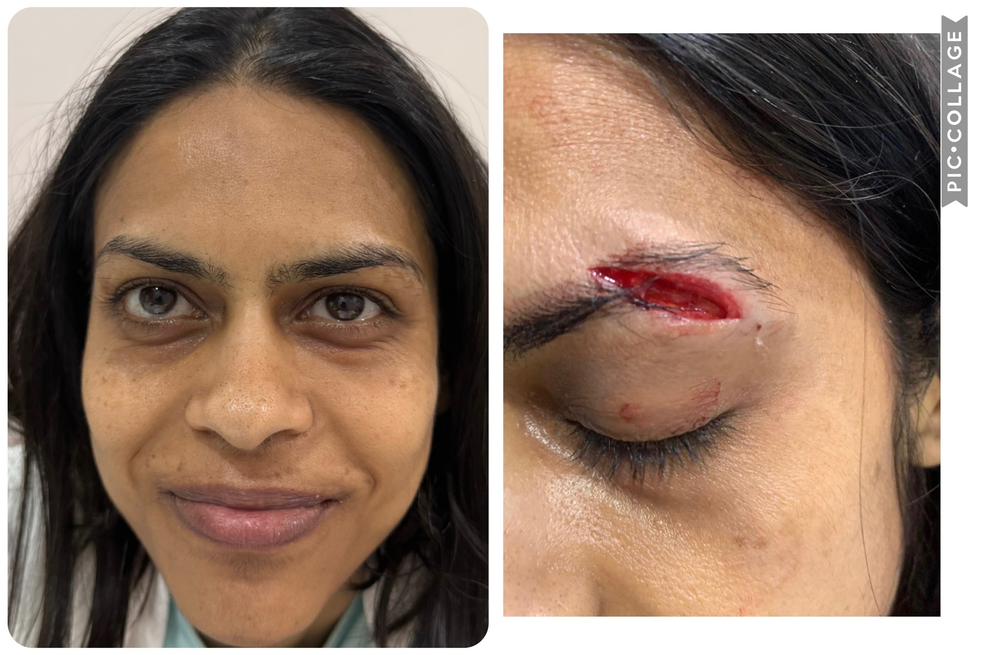 See the eyebrow alignment and NO scar 