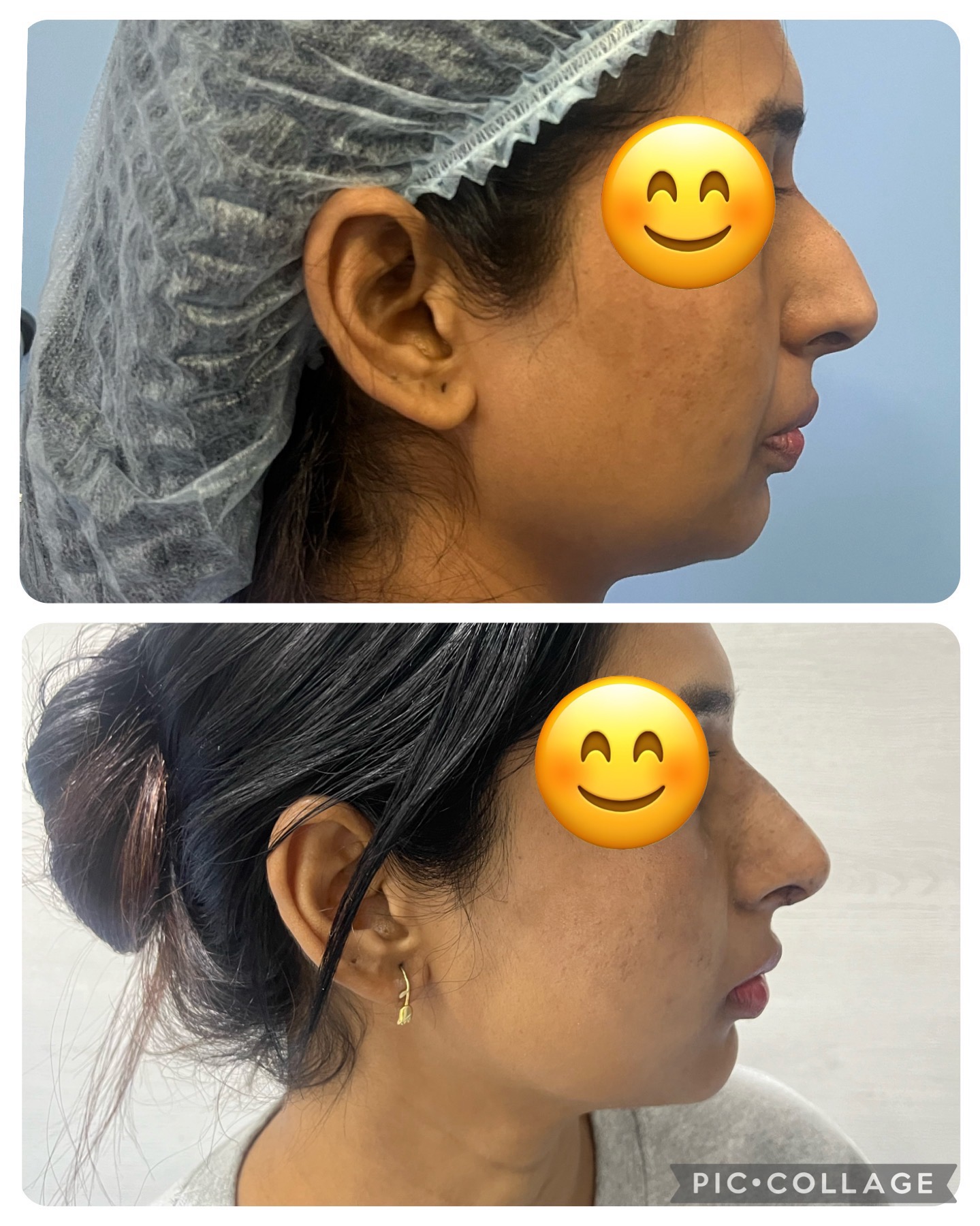 Rhinoplasty Life Transformation