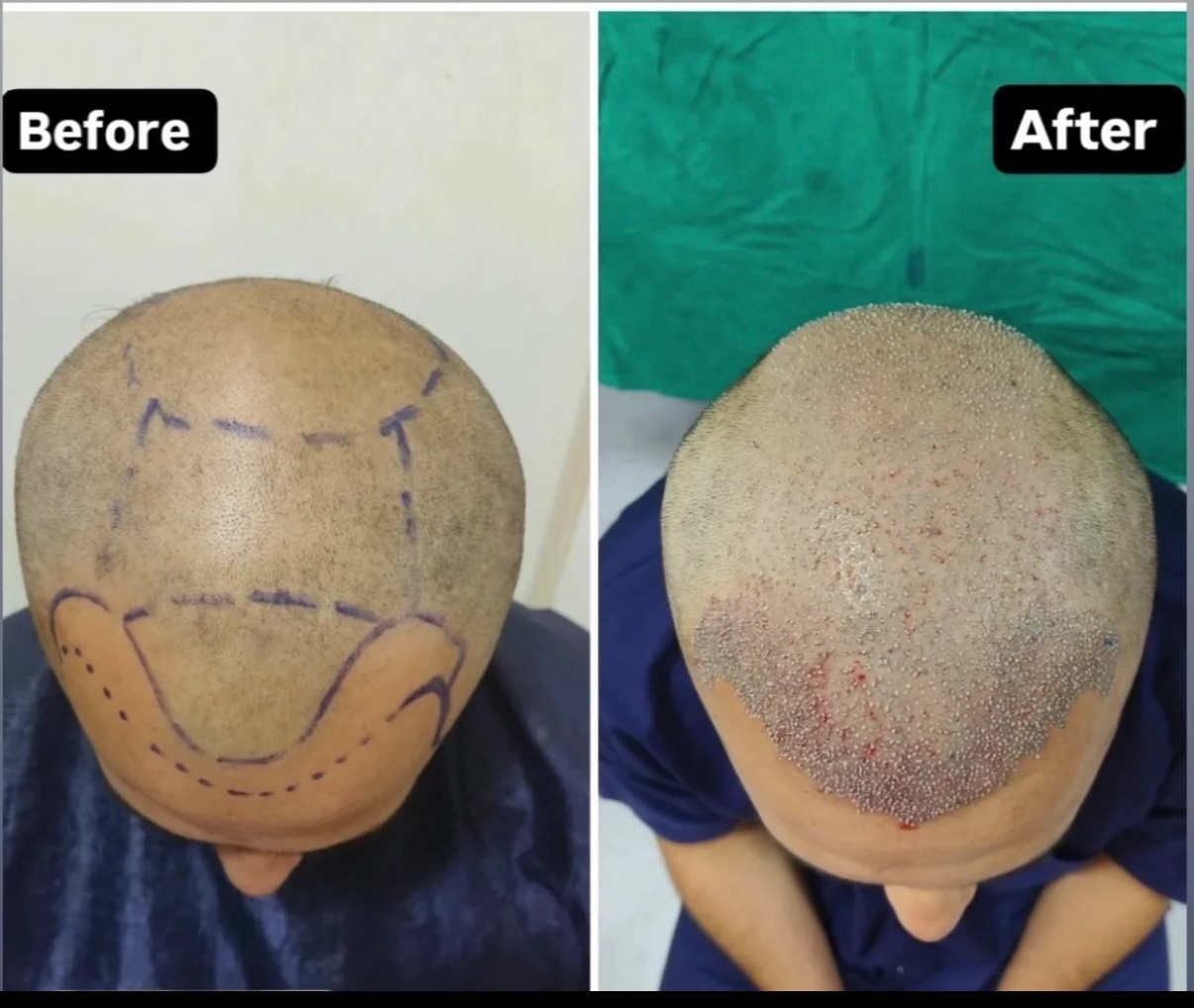 See the immediate results of hair transplant 
