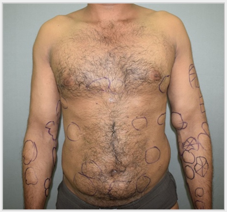 Multiple lipomatosis can affect whole body 