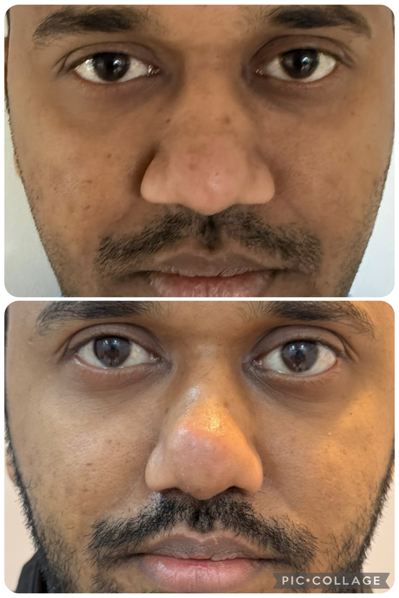 Broad nose correction 
