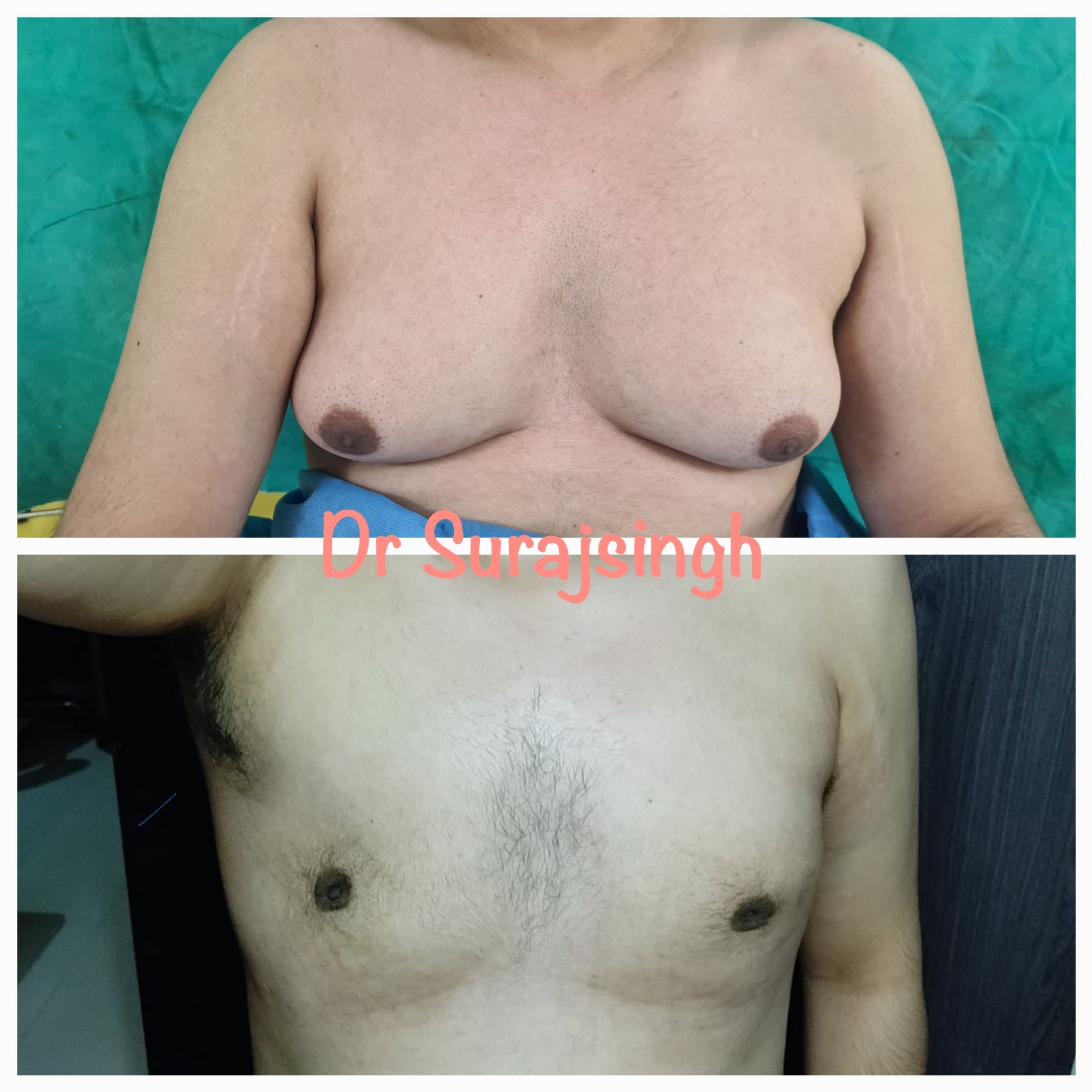 Patient lost weight but Gynecomastia remained same so corrected with surgery 