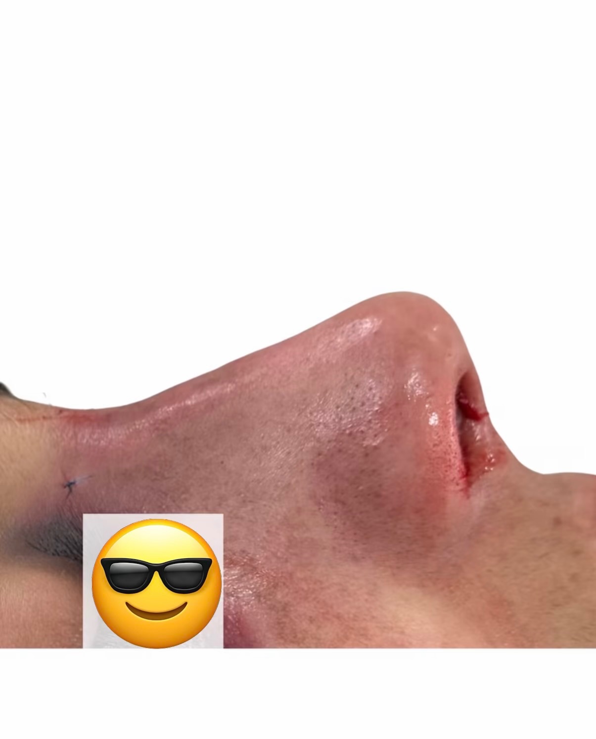 Silicone implant result