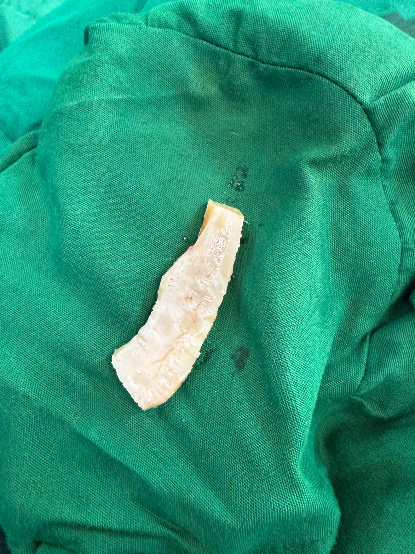 Rib cartilage is safe and permanent