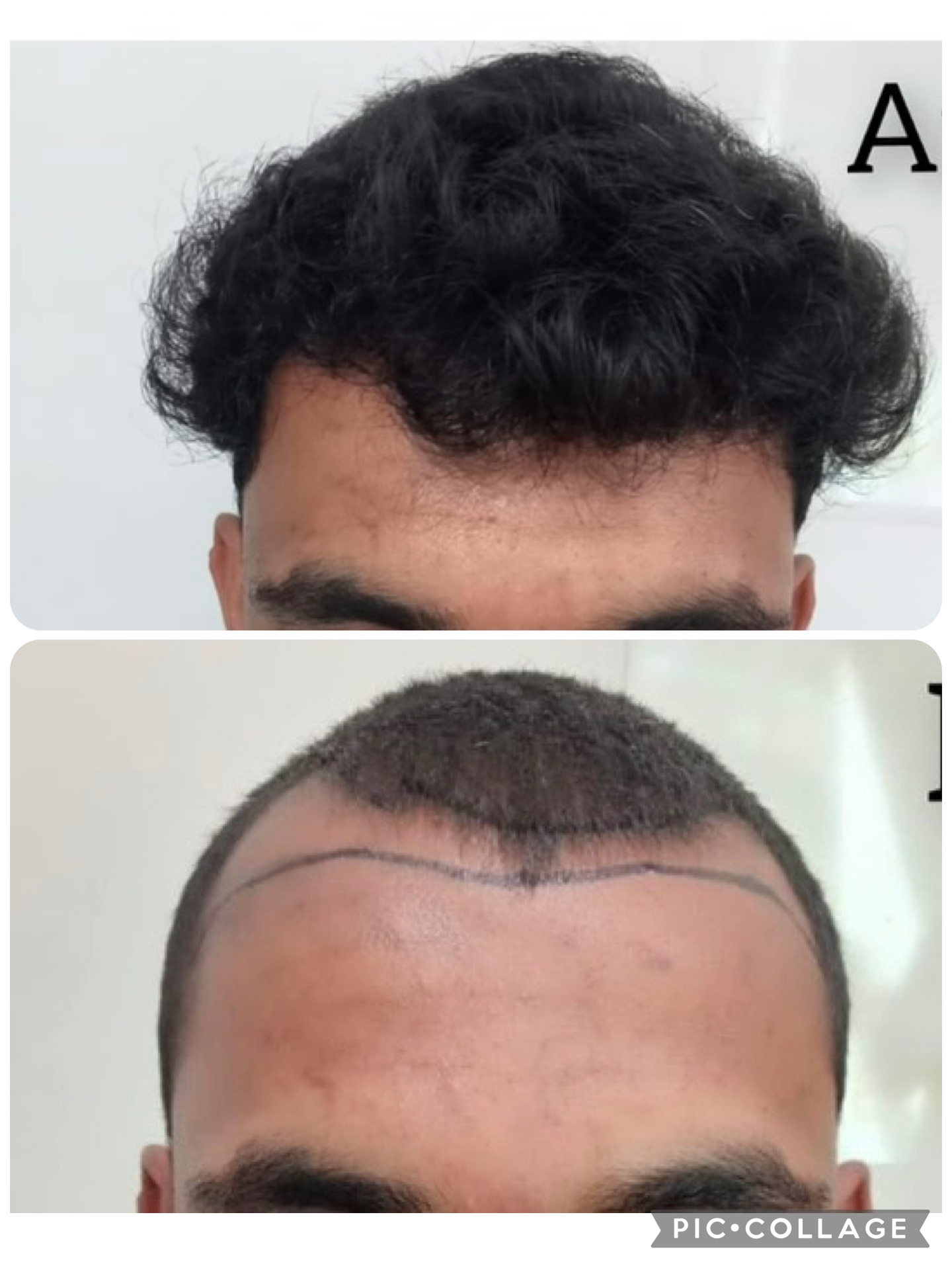 Hair transplant gives very good results 