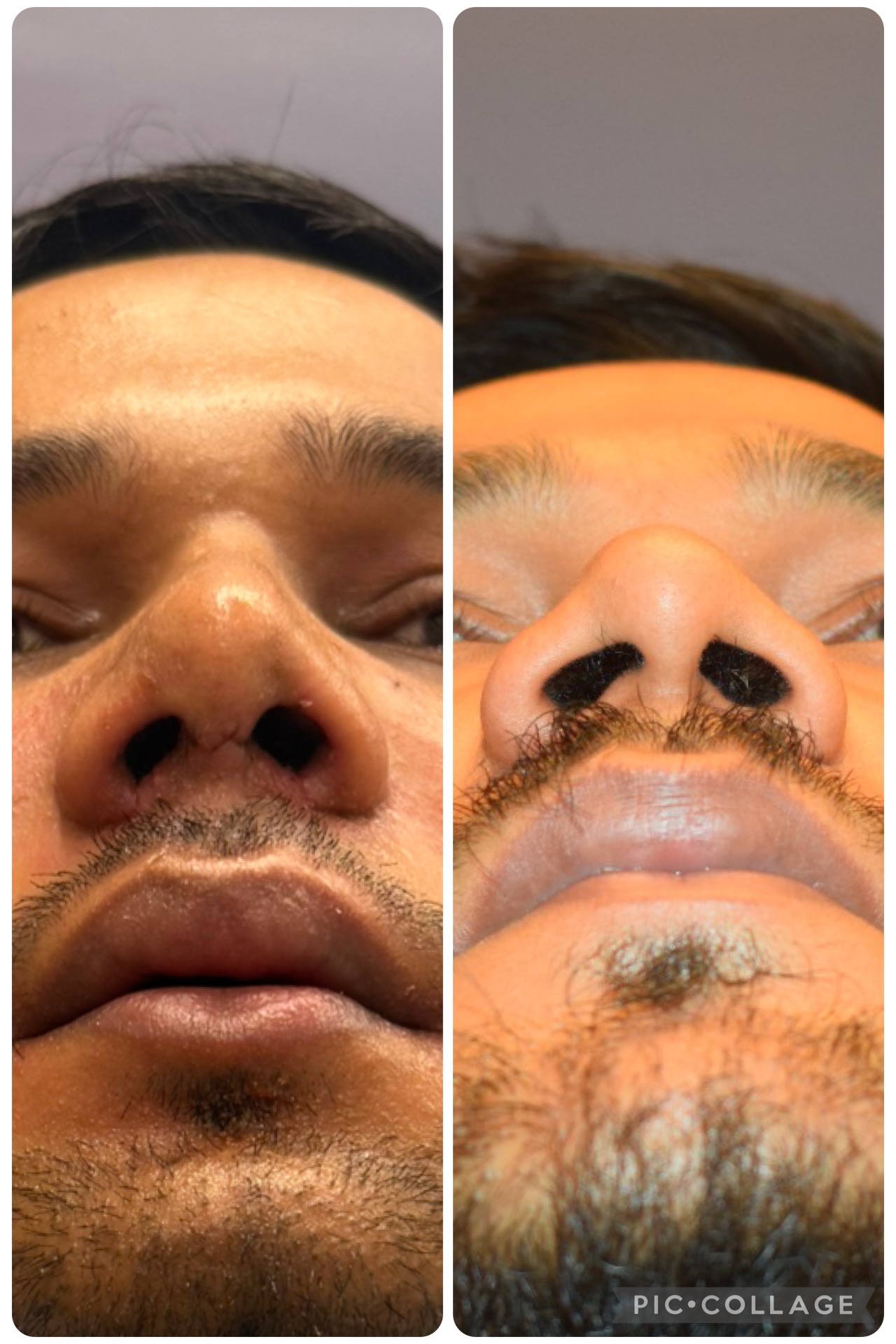 Notice the immediate difference in Nose framework after 1 week at the time of Splint removal 