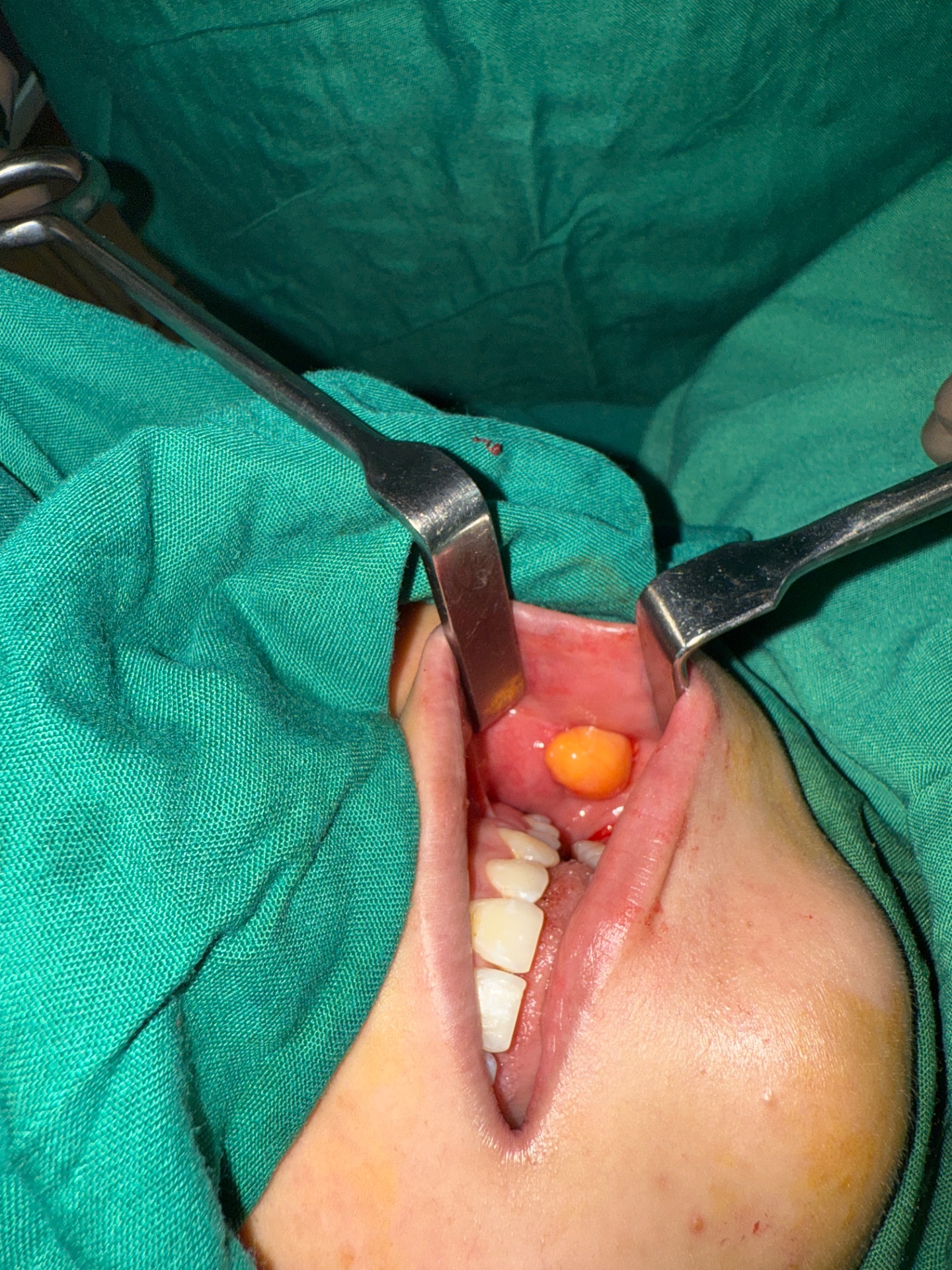 Buccal Fat Removal For V Shaped Look