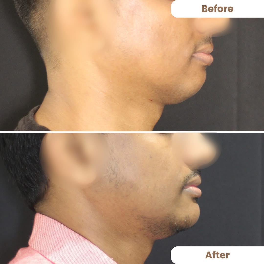 Implants give drastic change to your face 