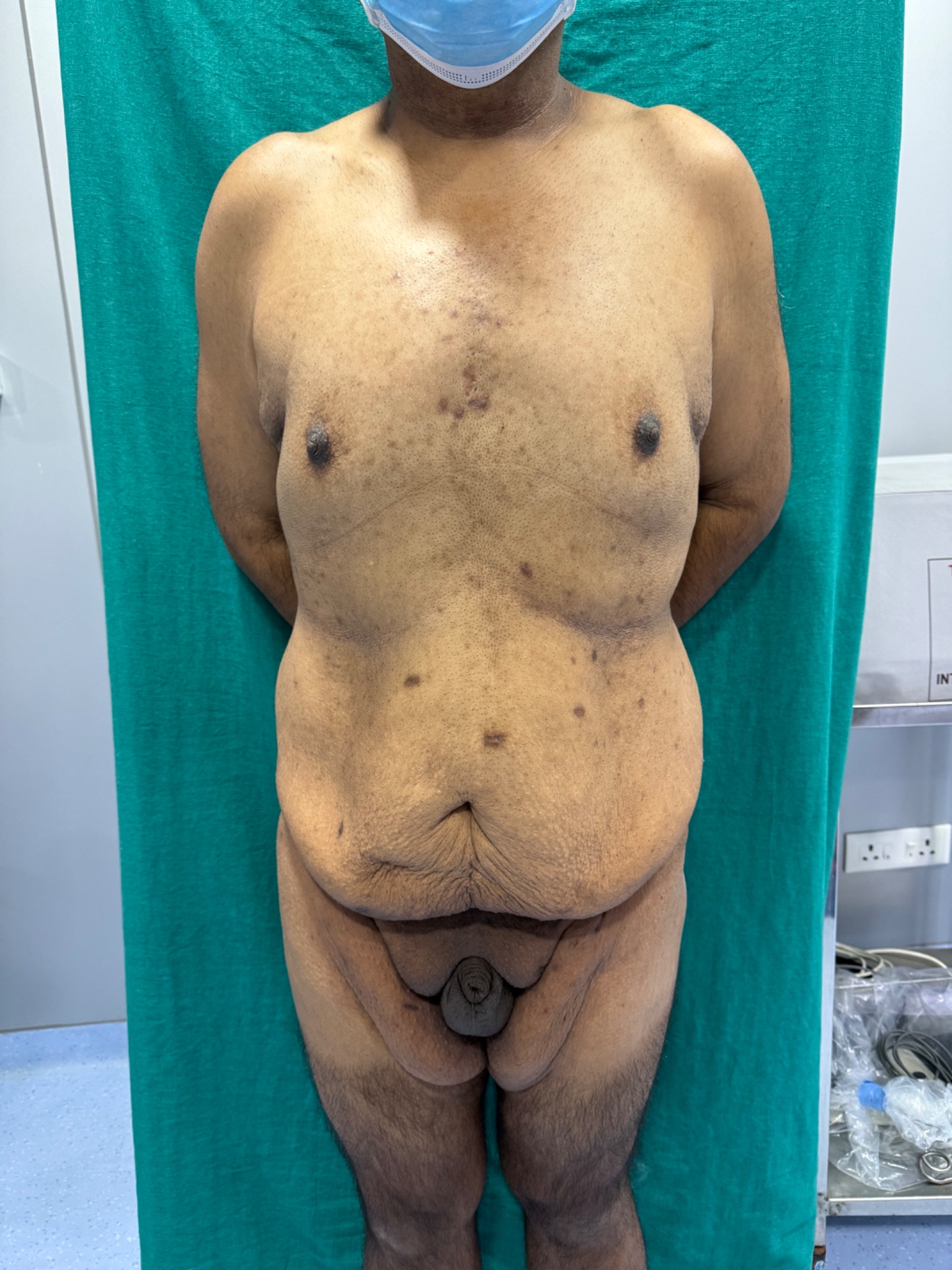 Body and Skin Changes after Bariatric surgery