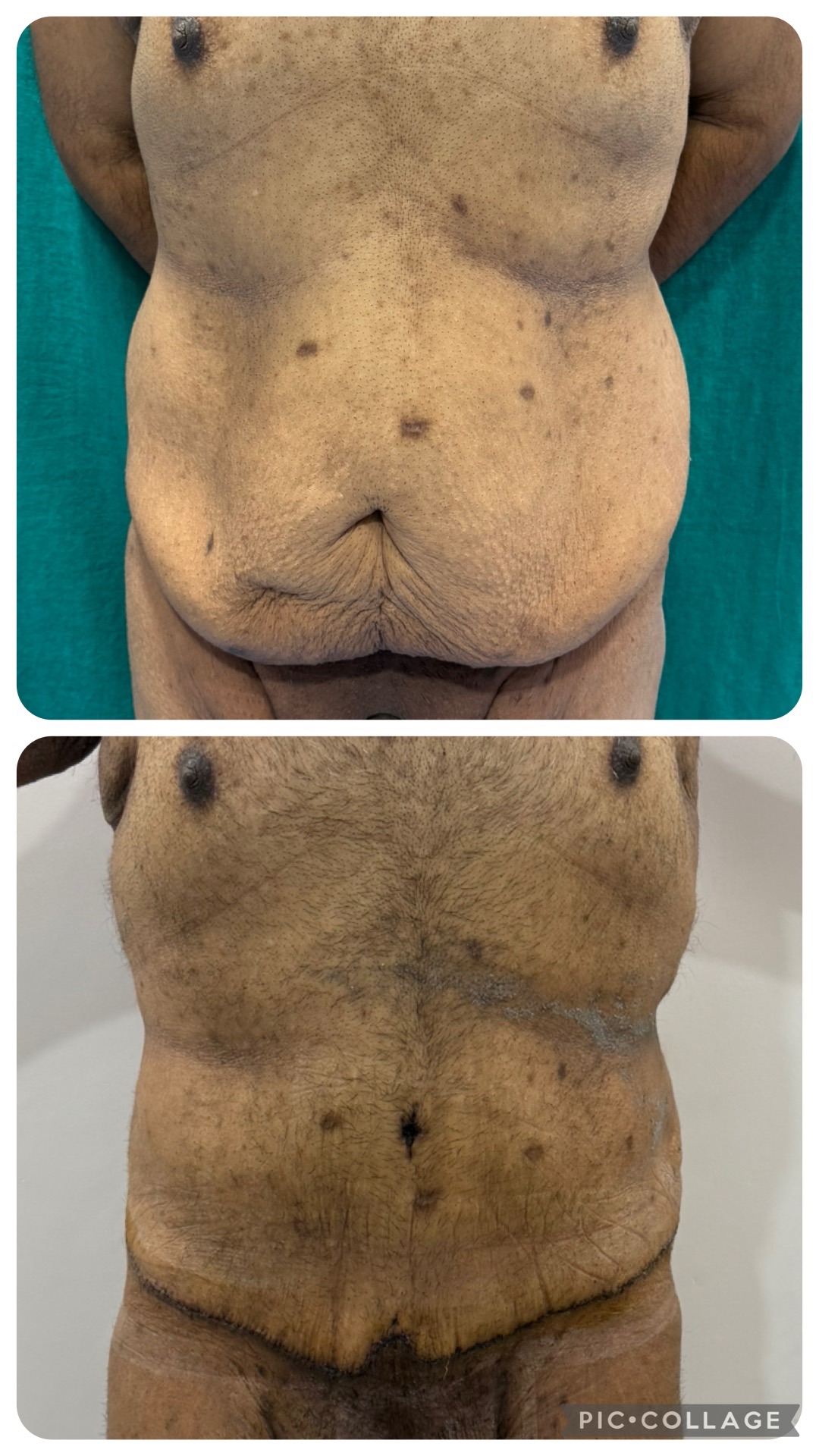 Perfect Body shape after Plastic Surgery