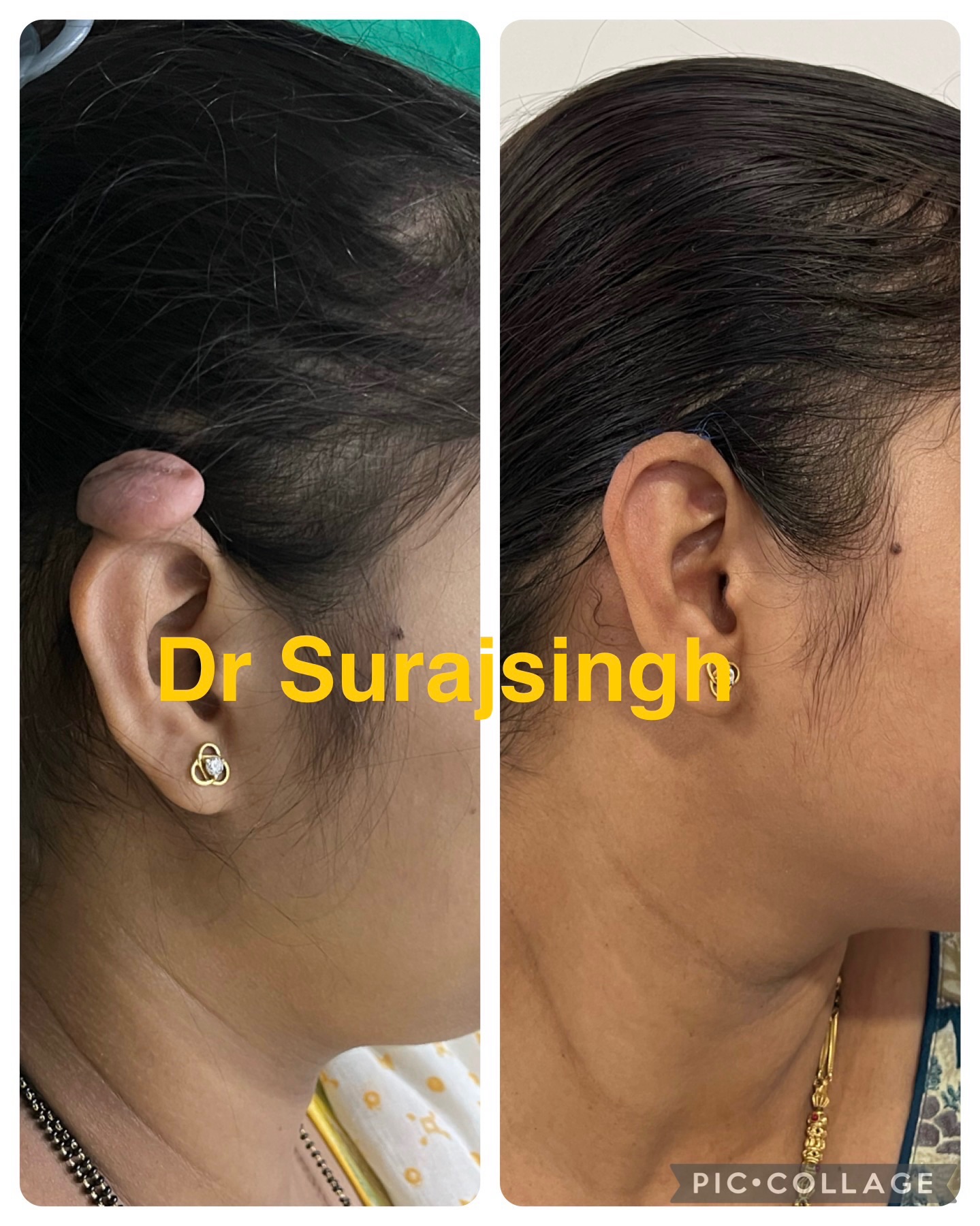 7 years follow up with NO recurrence 