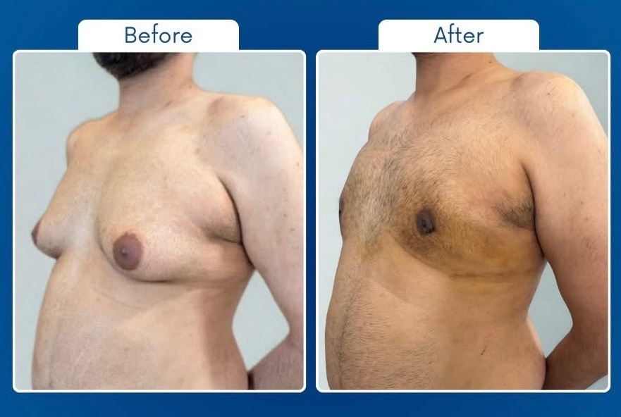Always Consult Experienced Plastic Surgeon for grade 3/4 Gynecomastia 