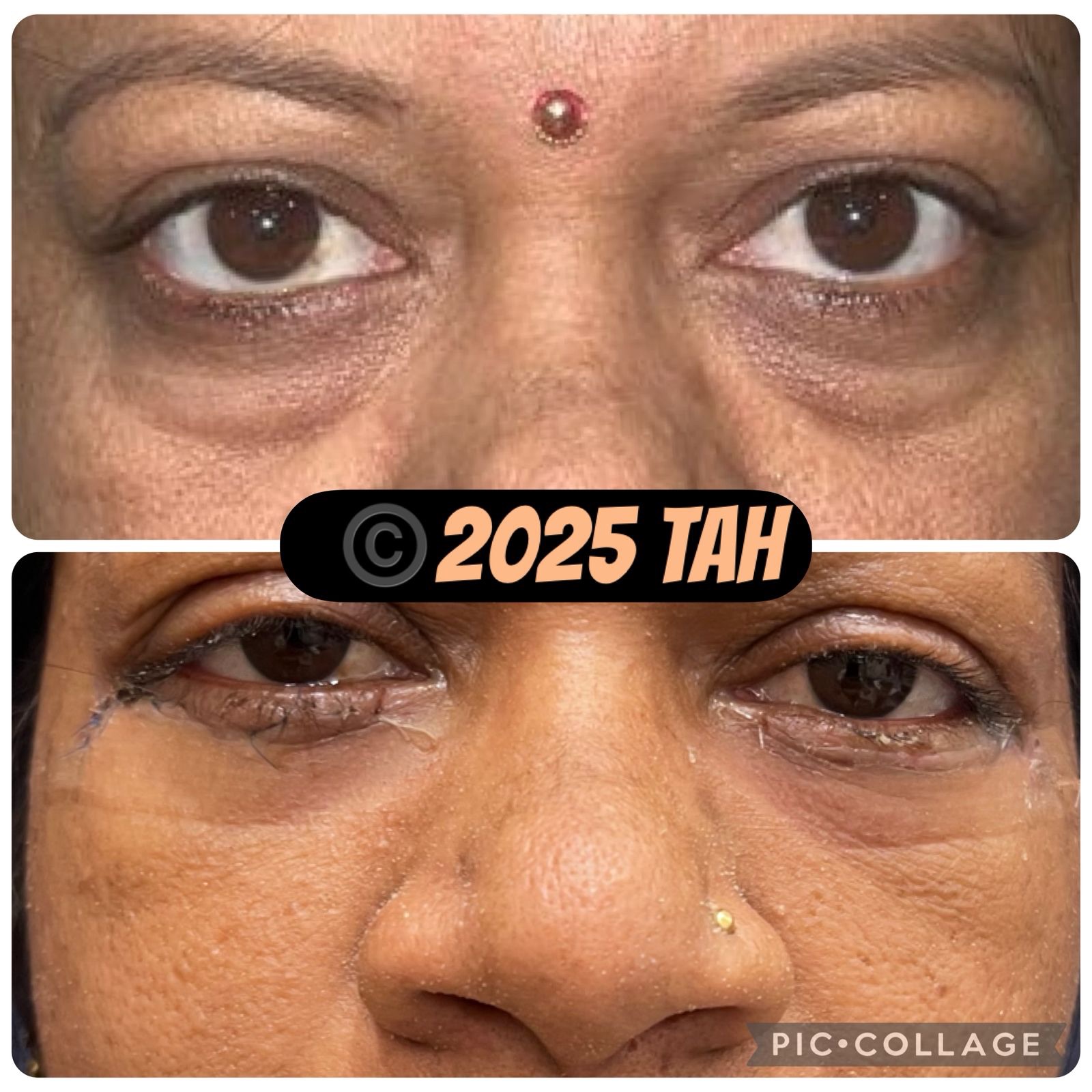 Blepharoplasty as Day care surgery