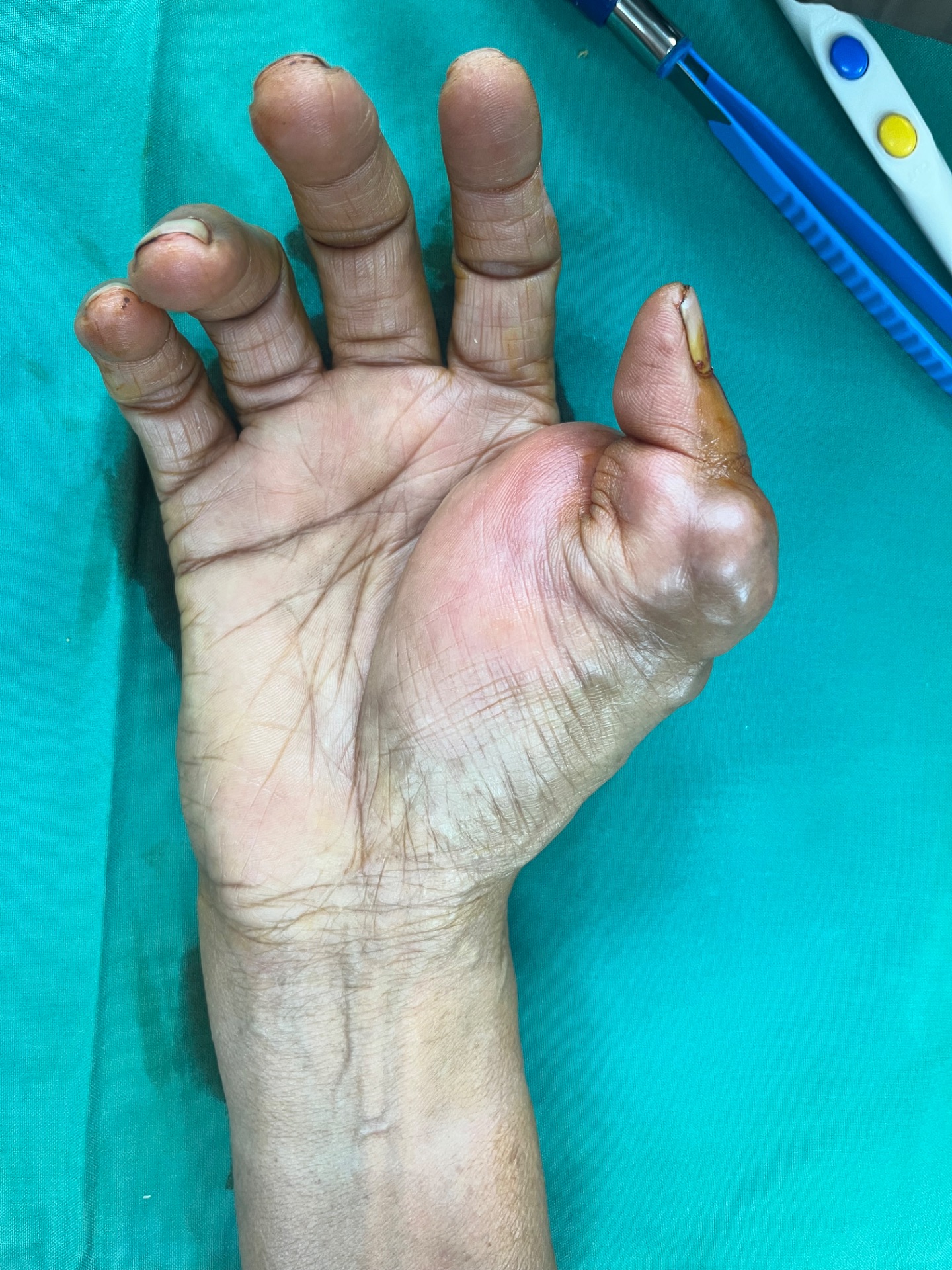 Hand lipoma 