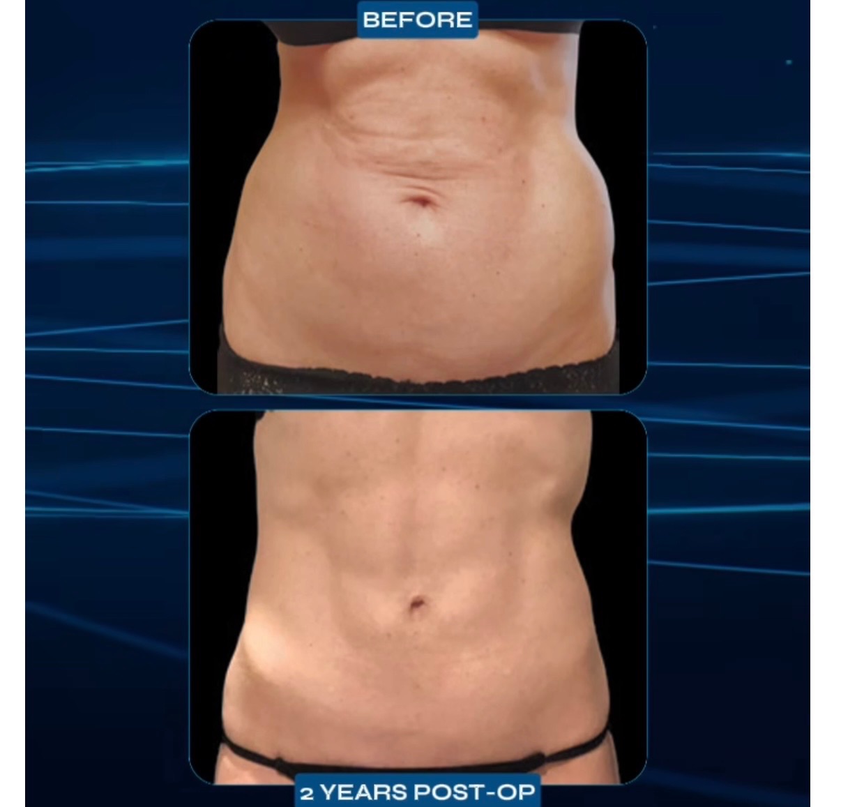 Results of VASER liposuction