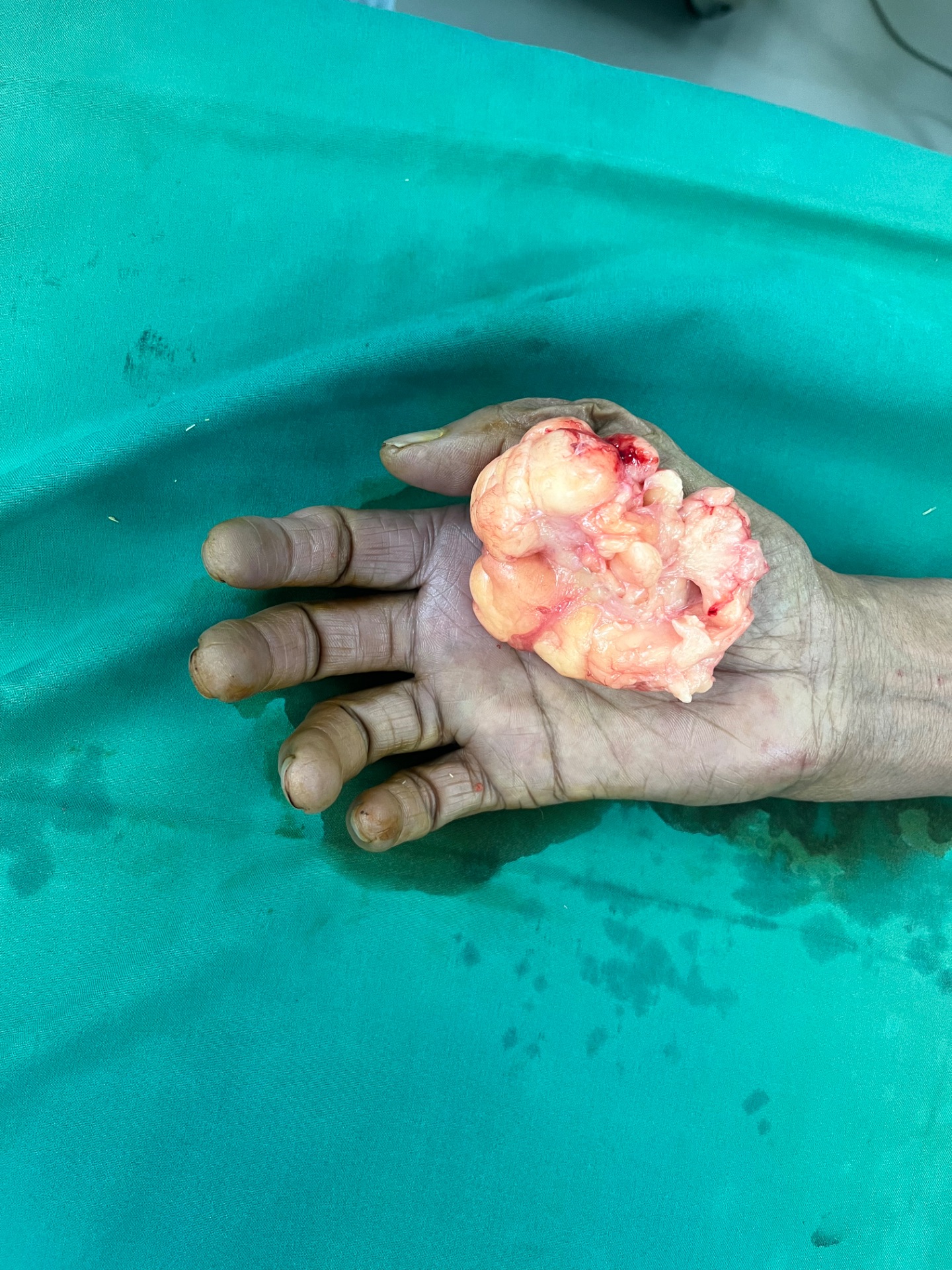 Complete excision by Plastic Surgeon gives good results 