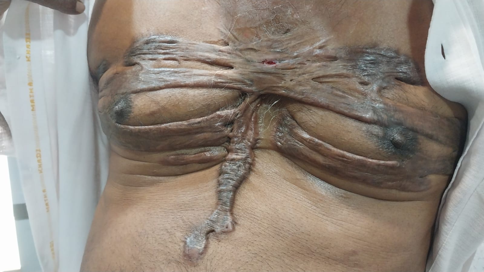 Keloid can be so worse and affects life 