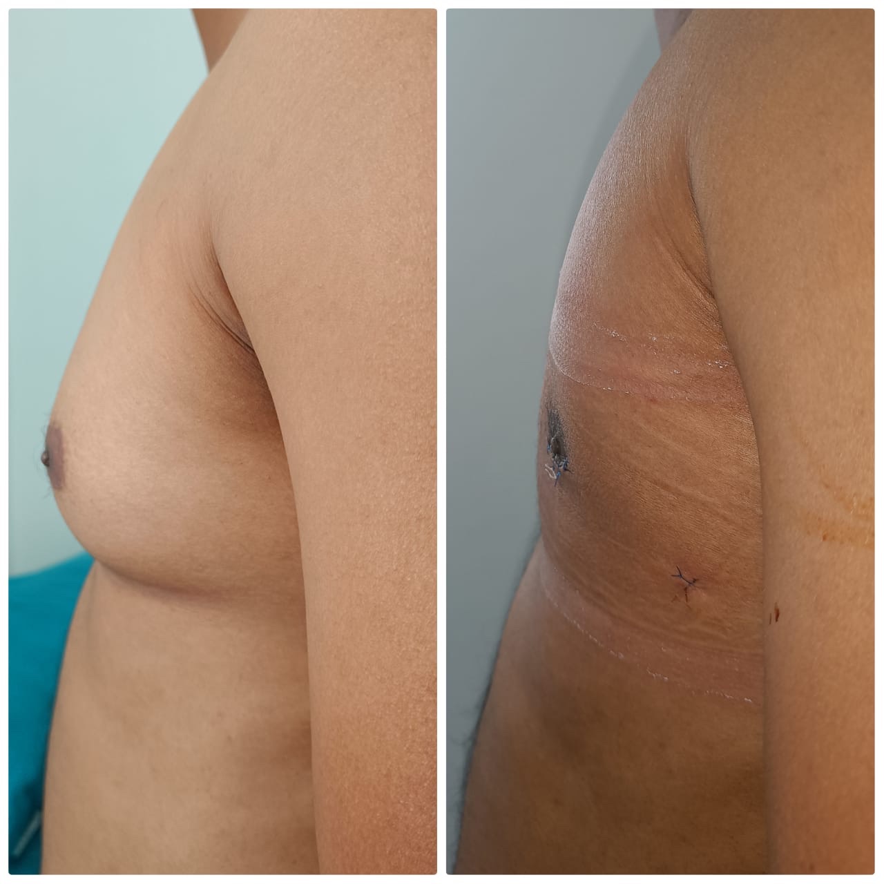 Proper 360 degree correction of chest 