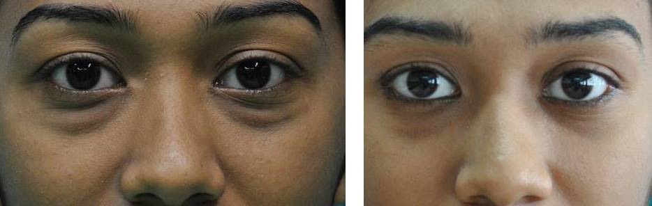 Lower lid bags gone completely 