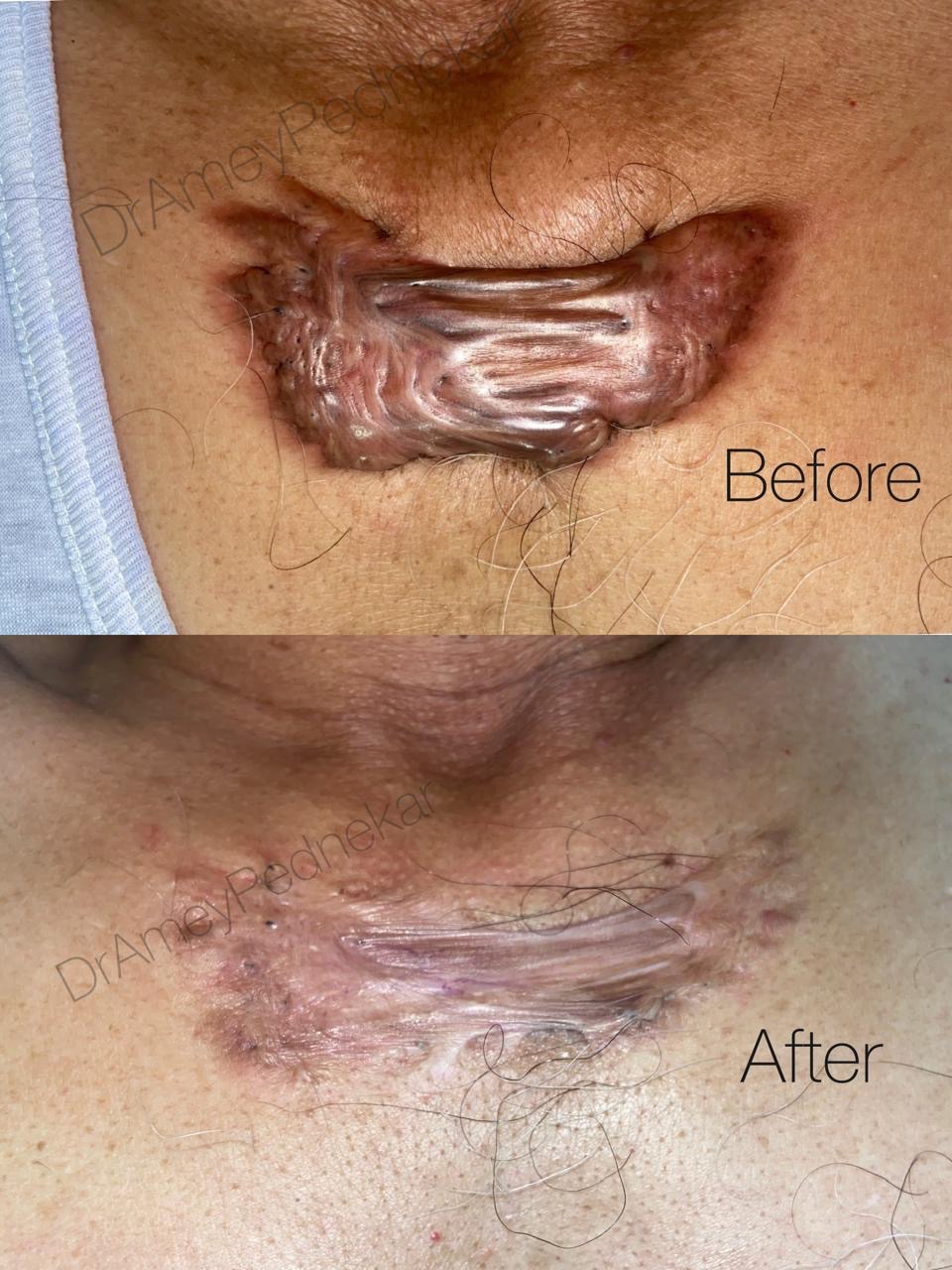 Keloid treated with injections and creams
