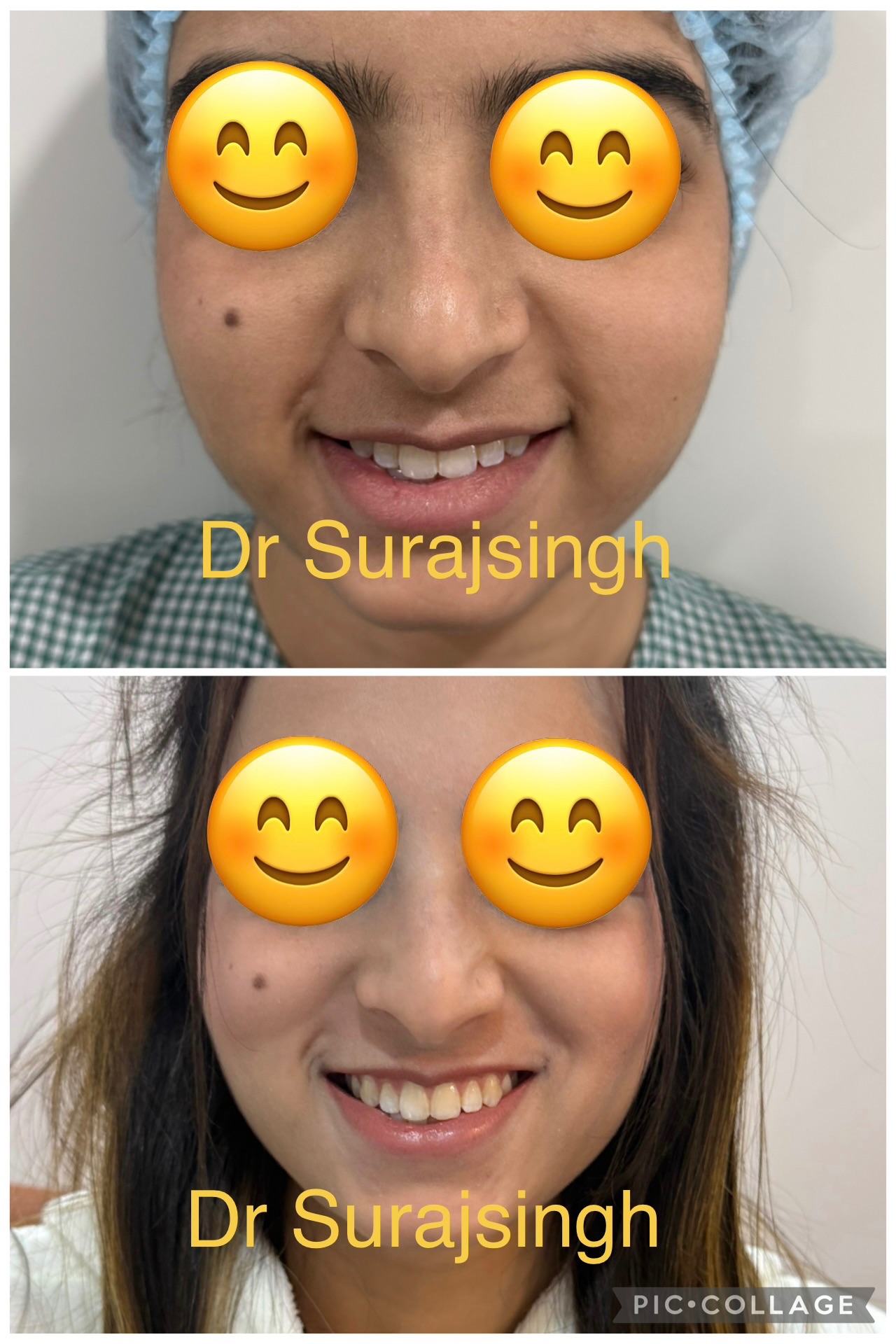 Liquid Rhinoplasty with Buccal fat reduction 