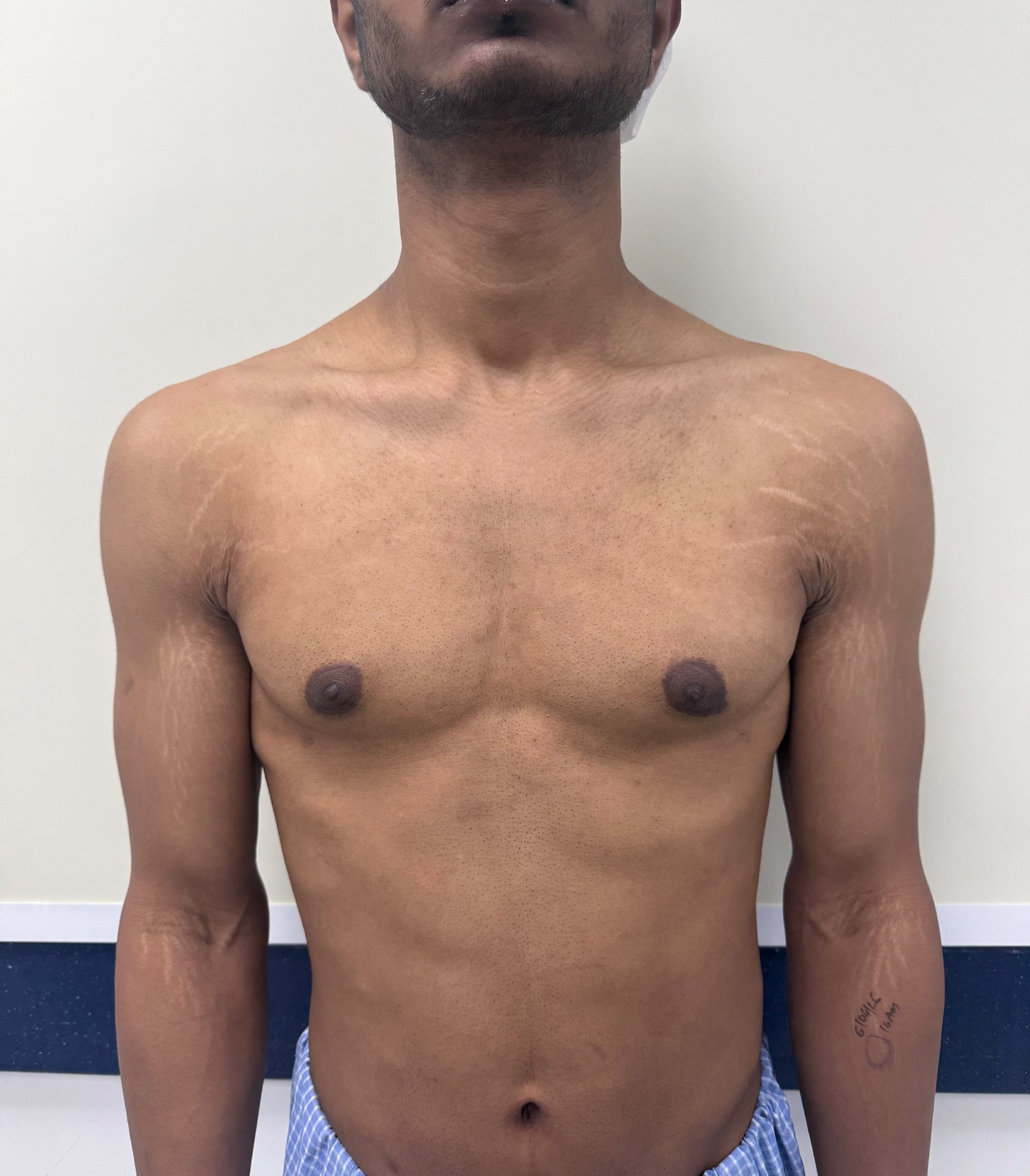 Patient operated 6 month back by normal surgeon but still Nipple pouting and gland felt
