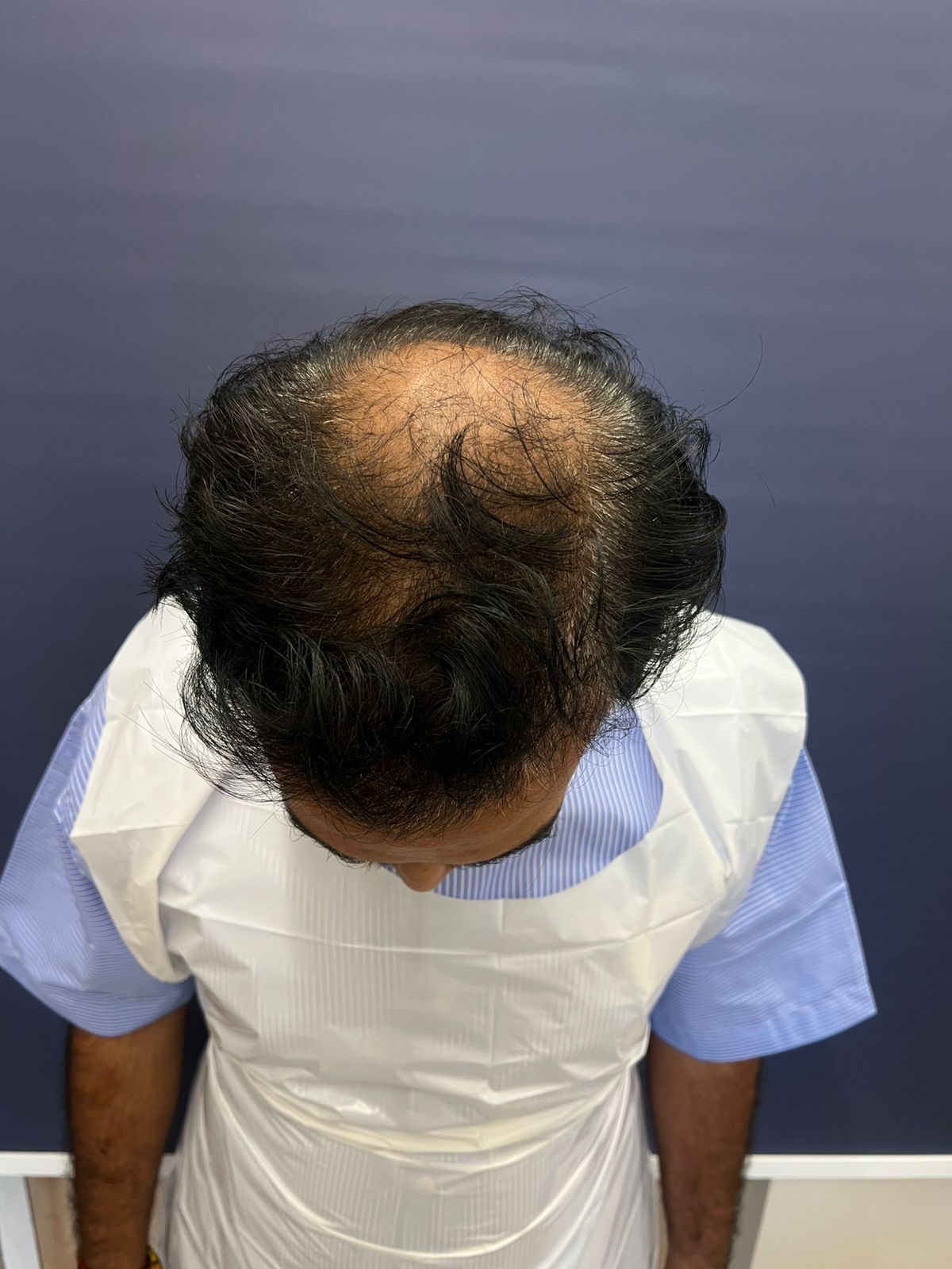 Person in 40s with vertex patch affecting professional life 