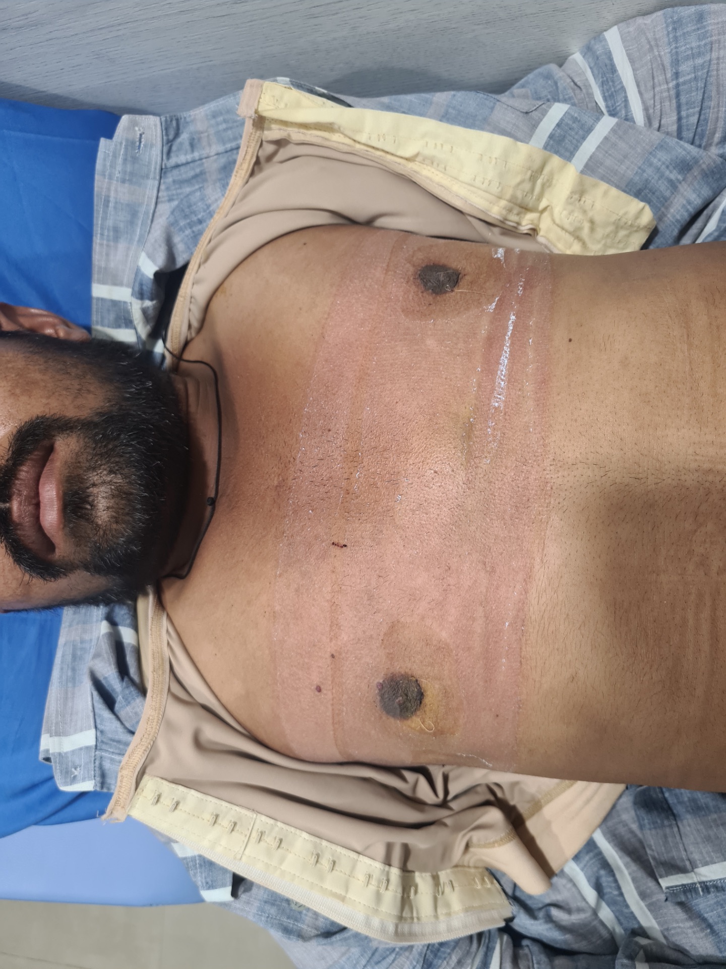 Using pressure garment immediately after surgery can reduce Seroma & Hematoma