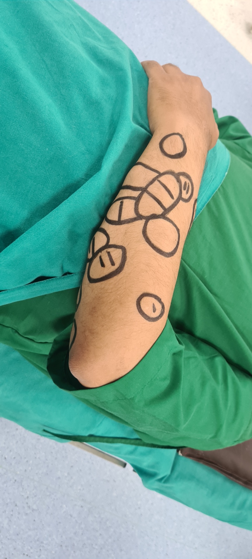 Most of the people develop lipoma on upper limb 