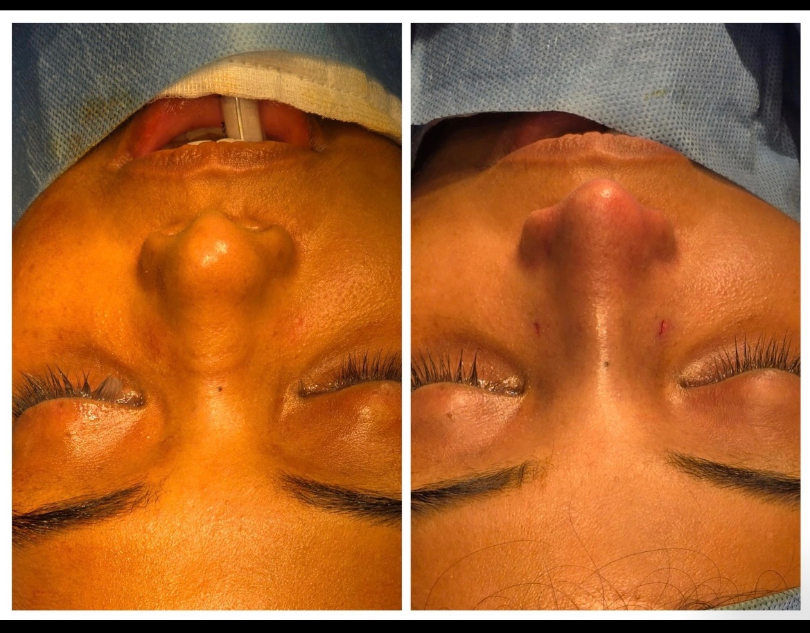 Rib cartilage results