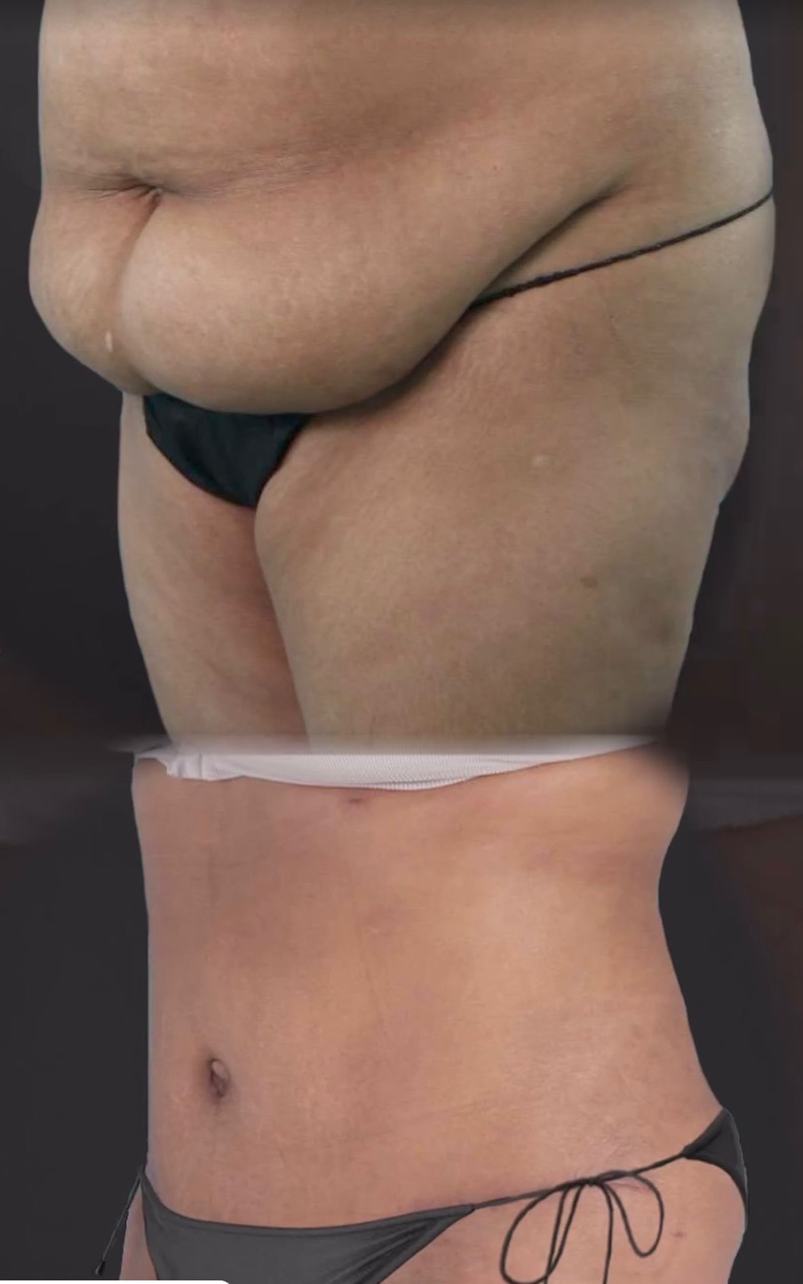 Abdomen re shaping as part of Mommy Makeover 