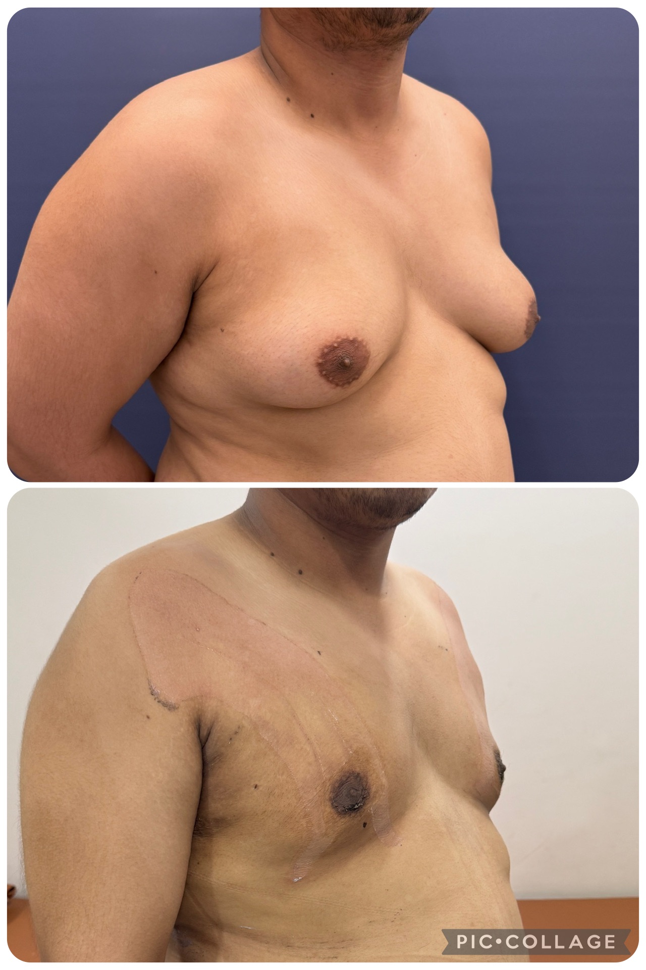 Get best results without skin excision 