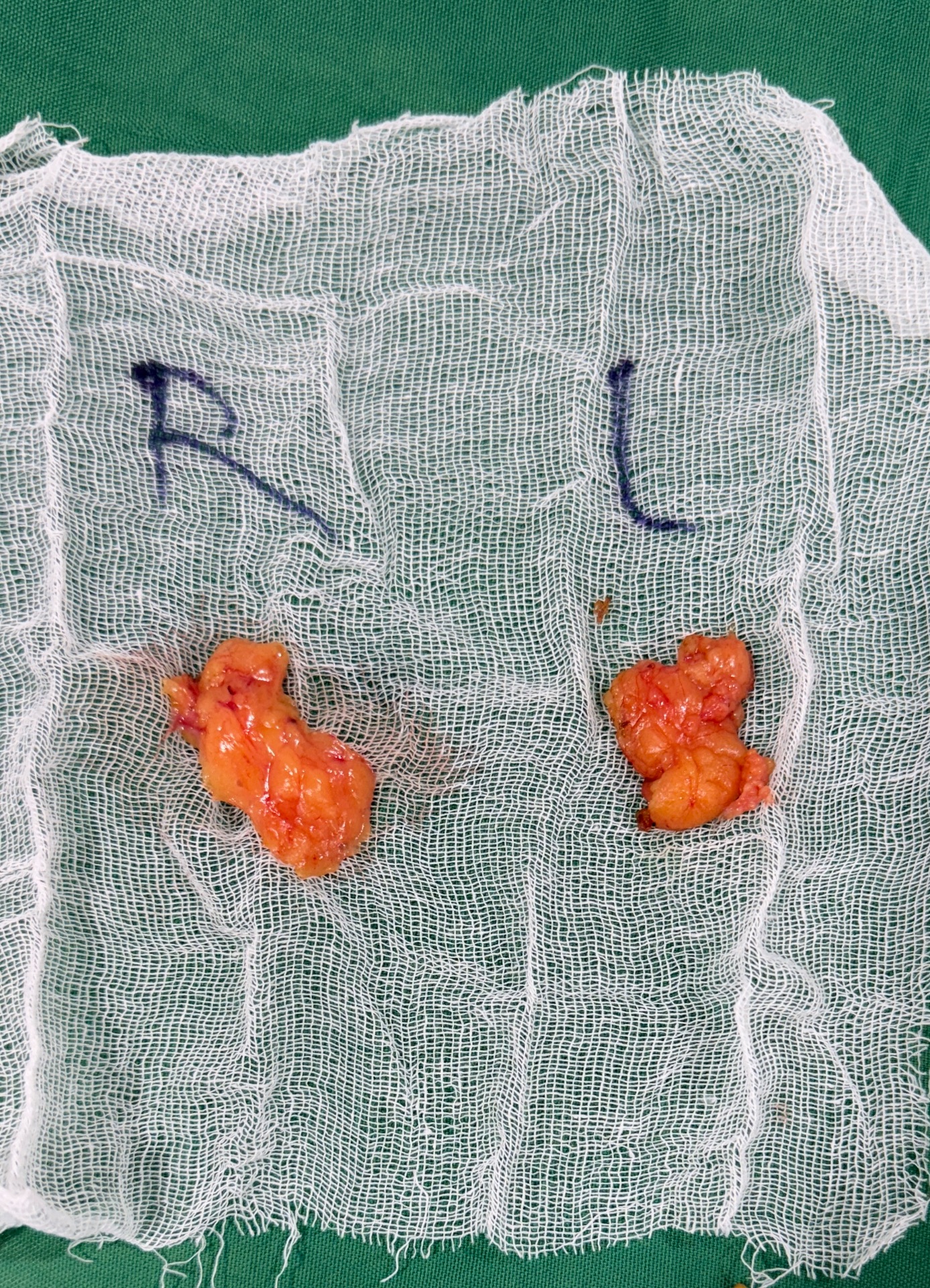 See the removed equal Buccal fat