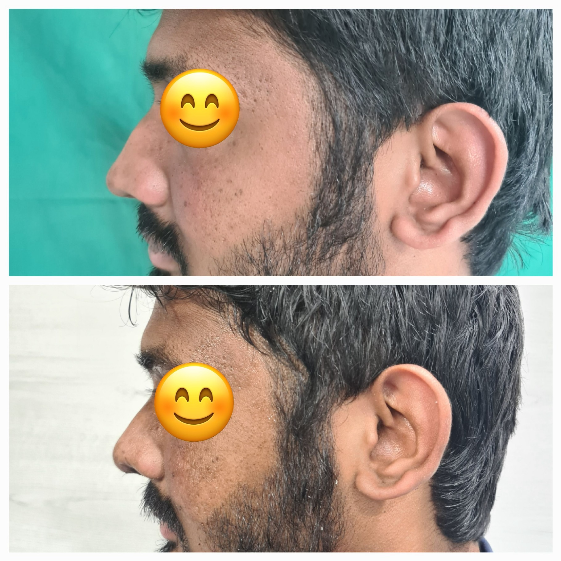 Liquid Rhinoplasty results are immediate 