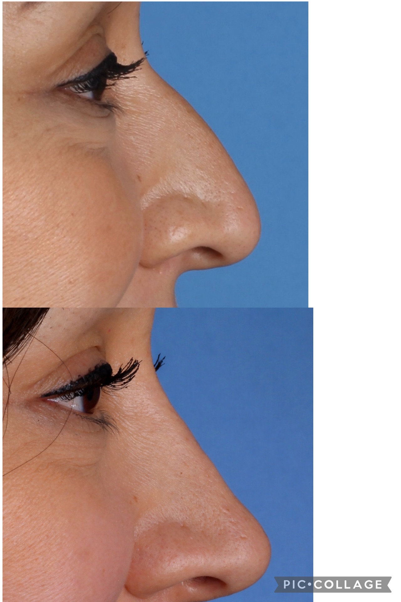 Surgical Rhinoplasty results are permanent 
